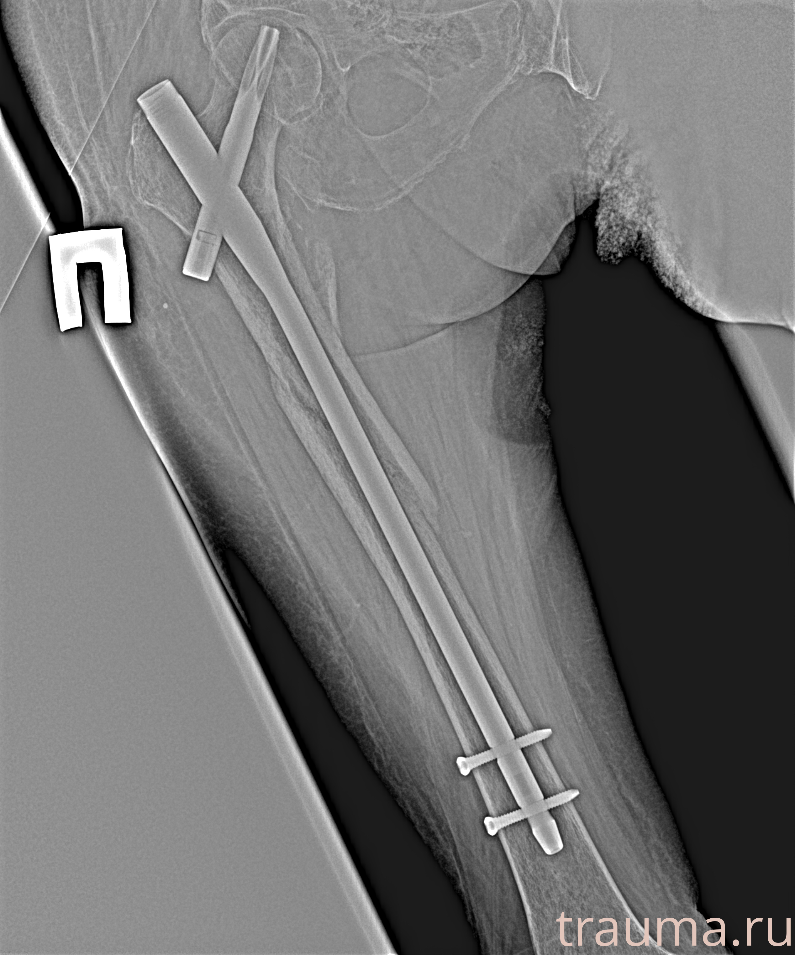 Рентген на дому: по вашему адресу приезжает врач-рентгенолог, травматолог-ортопед с мобильным рентгеновским аппаратом, проводит диагностику травмы или заболевания, делает необходимые рентгенограммы, дает рекомендации по дальнейшему лечению. Получить качественные снимки в домашних условиях возможно благодаря уникальной методике, разработанной МосРентген Центром для института  Склифосовского