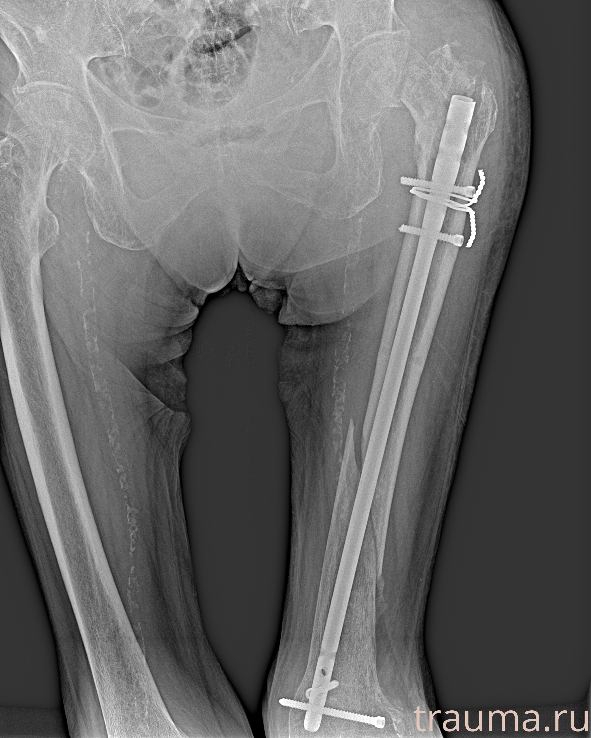 Рентген на дому: по вашему адресу приезжает врач-рентгенолог, травматолог-ортопед с мобильным рентгеновским аппаратом, проводит диагностику травмы или заболевания, делает необходимые рентгенограммы, дает рекомендации по дальнейшему лечению. Получить качественные снимки в домашних условиях возможно благодаря уникальной методике, разработанной МосРентген Центром для института  Склифосовского