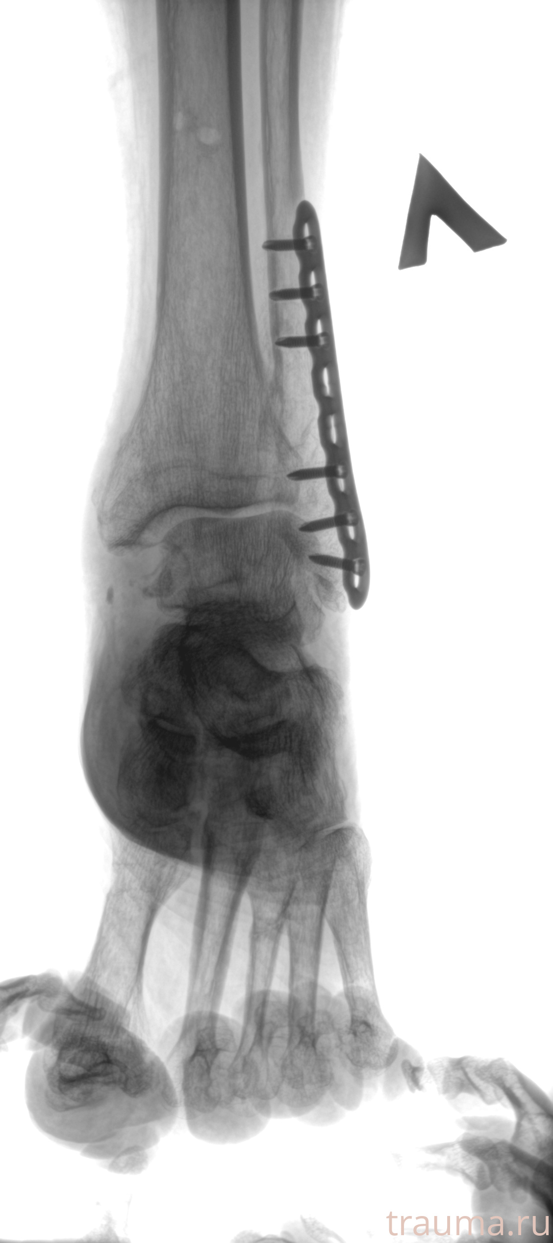 Рентген на дому: по вашему адресу приезжает врач-рентгенолог, травматолог-ортопед с мобильным рентгеновским аппаратом, проводит диагностику травмы или заболевания, делает необходимые рентгенограммы, дает рекомендации по дальнейшему лечению. Получить качественные снимки в домашних условиях возможно благодаря уникальной методике, разработанной МосРентген Центром для института  Склифосовского