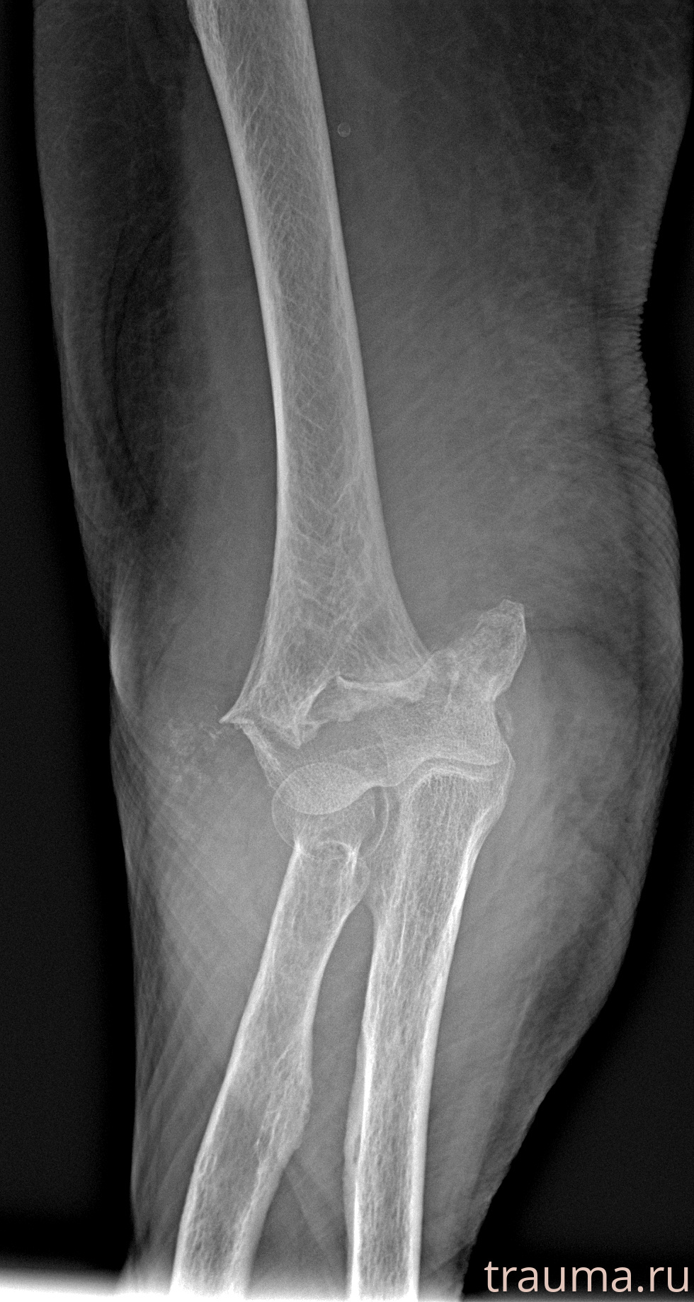 Рентген на дому: по вашему адресу приезжает врач-рентгенолог, травматолог-ортопед с мобильным рентгеновским аппаратом, проводит диагностику травмы или заболевания, делает необходимые рентгенограммы, дает рекомендации по дальнейшему лечению. Получить качественные снимки в домашних условиях возможно благодаря уникальной методике, разработанной МосРентген Центром для института  Склифосовского