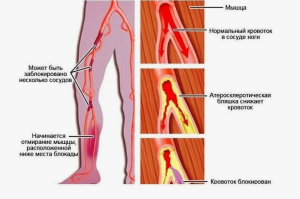 Клинические примеры эффективного применения пентоксифиллина у пациентов с перемежающейся хромотой и сопутствующей патологией Клинические примеры эффективного применения пентоксифиллина у пациентов с перемежающейся хромотой и сопутствующей патологией