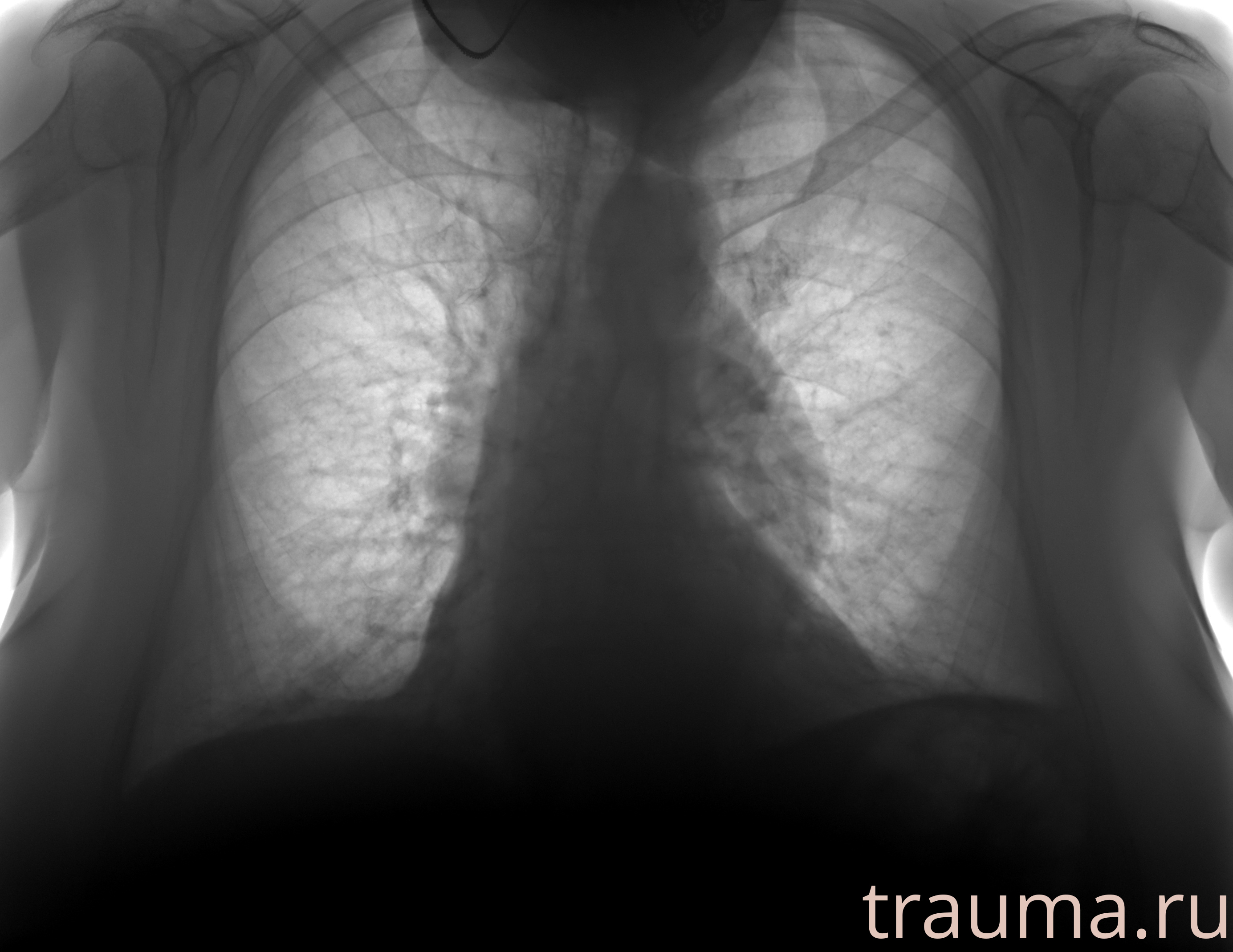Рентген на дому: по вашему адресу приезжает врач-рентгенолог, травматолог-ортопед с мобильным рентгеновским аппаратом, проводит диагностику травмы или заболевания, делает необходимые рентгенограммы, дает рекомендации по дальнейшему лечению. Получить качественные снимки в домашних условиях возможно благодаря уникальной методике, разработанной МосРентген Центром для института  Склифосовского