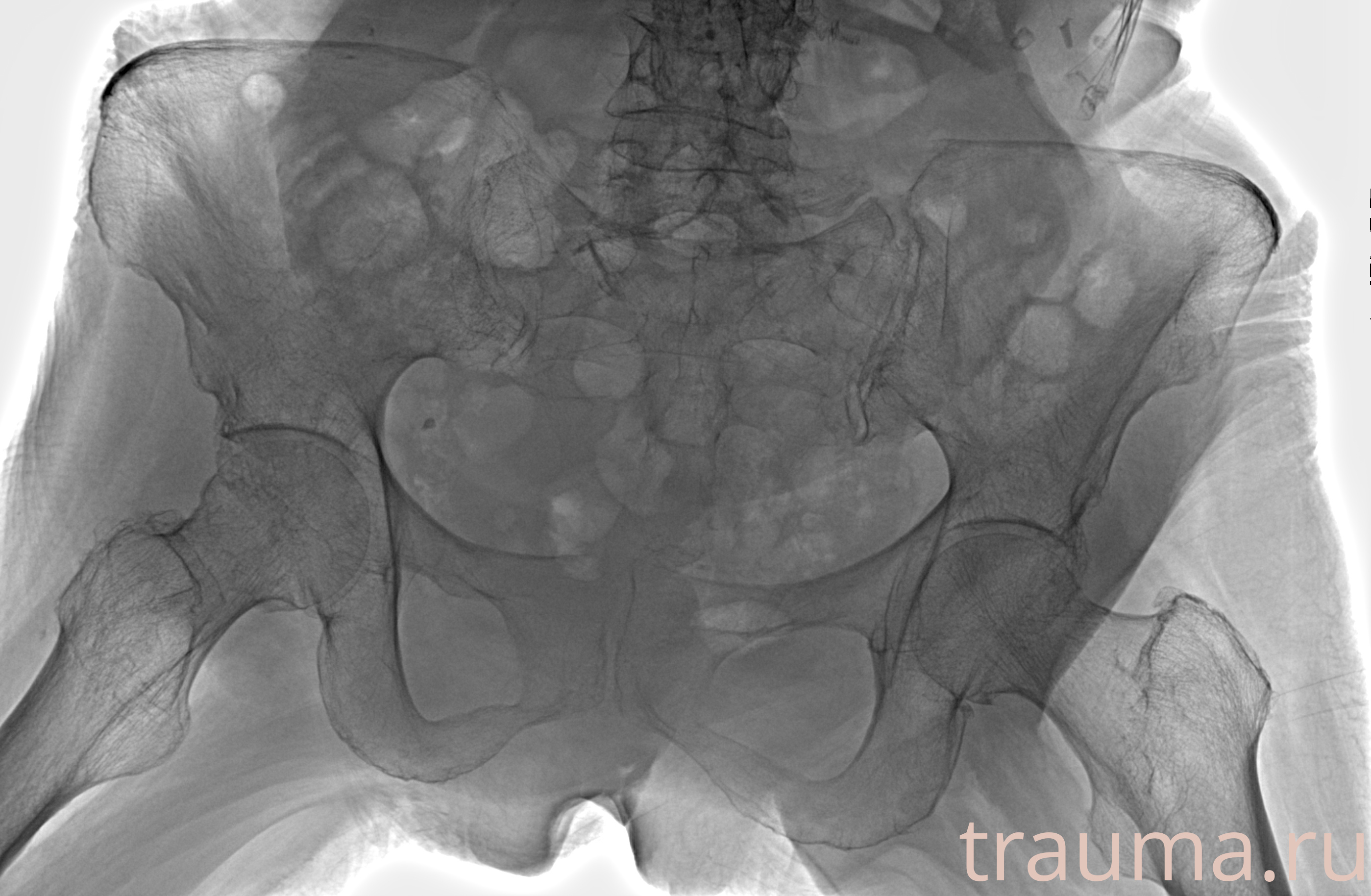 Рентген на дому: по вашему адресу приезжает врач-рентгенолог, травматолог-ортопед с мобильным рентгеновским аппаратом, проводит диагностику травмы или заболевания, делает необходимые рентгенограммы, дает рекомендации по дальнейшему лечению. Получить качественные снимки в домашних условиях возможно благодаря уникальной методике, разработанной МосРентген Центром для института  Склифосовского