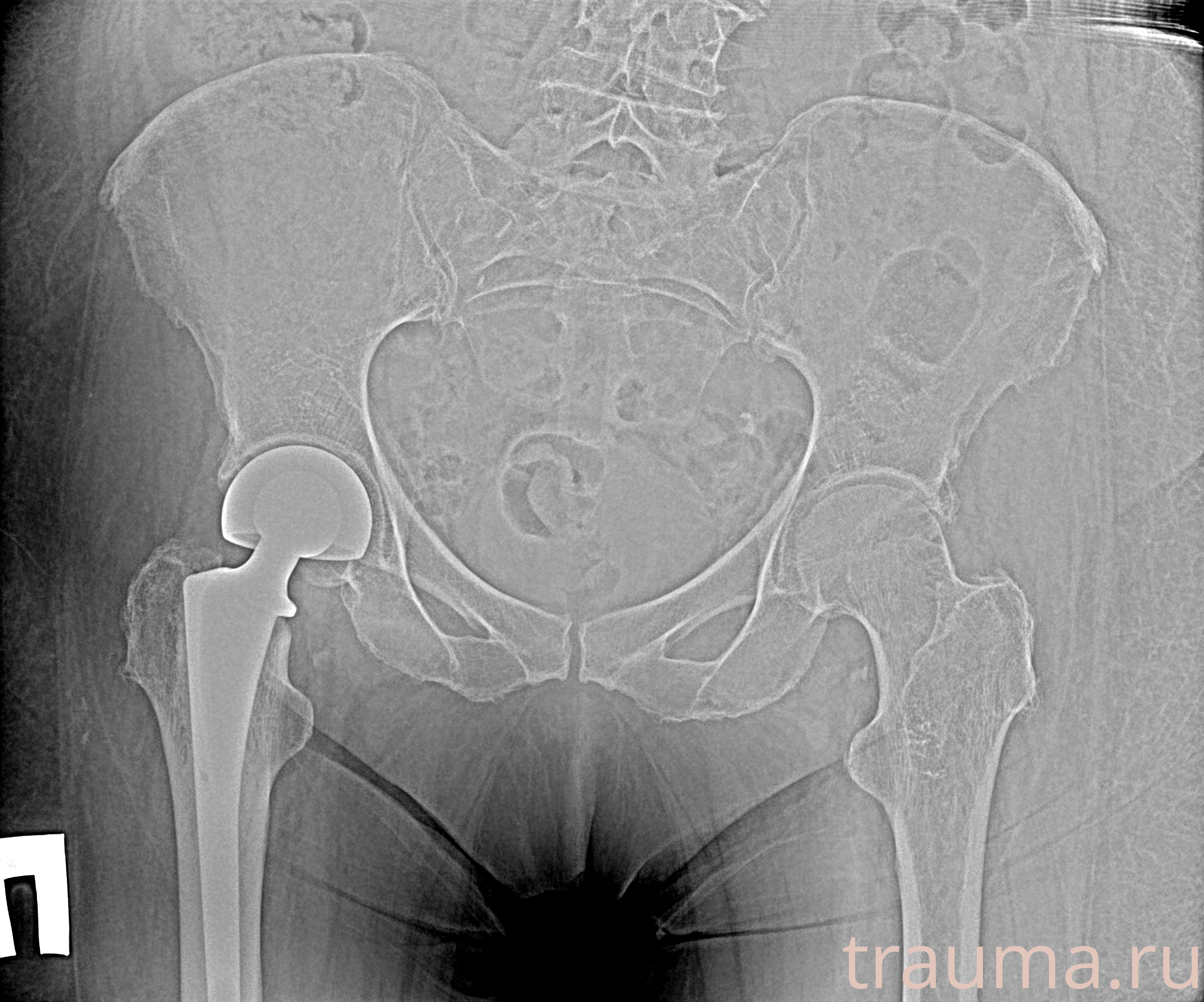 Рентген на дому: по вашему адресу приезжает врач-рентгенолог, травматолог-ортопед с мобильным рентгеновским аппаратом, проводит диагностику травмы или заболевания, делает необходимые рентгенограммы, дает рекомендации по дальнейшему лечению. Получить качественные снимки в домашних условиях возможно благодаря уникальной методике, разработанной МосРентген Центром для института  Склифосовского
