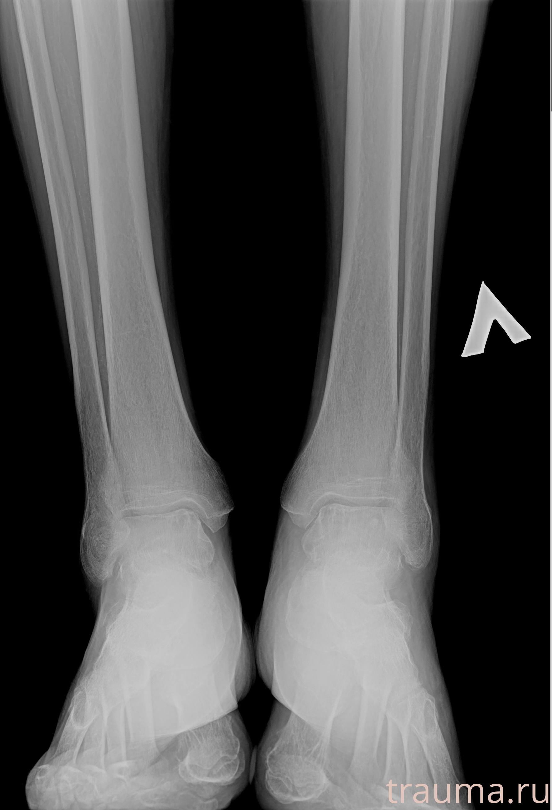 Рентген на дому: по вашему адресу приезжает врач-рентгенолог, травматолог-ортопед с мобильным рентгеновским аппаратом, проводит диагностику травмы или заболевания, делает необходимые рентгенограммы, дает рекомендации по дальнейшему лечению. Получить качественные снимки в домашних условиях возможно благодаря уникальной методике, разработанной МосРентген Центром для института  Склифосовского