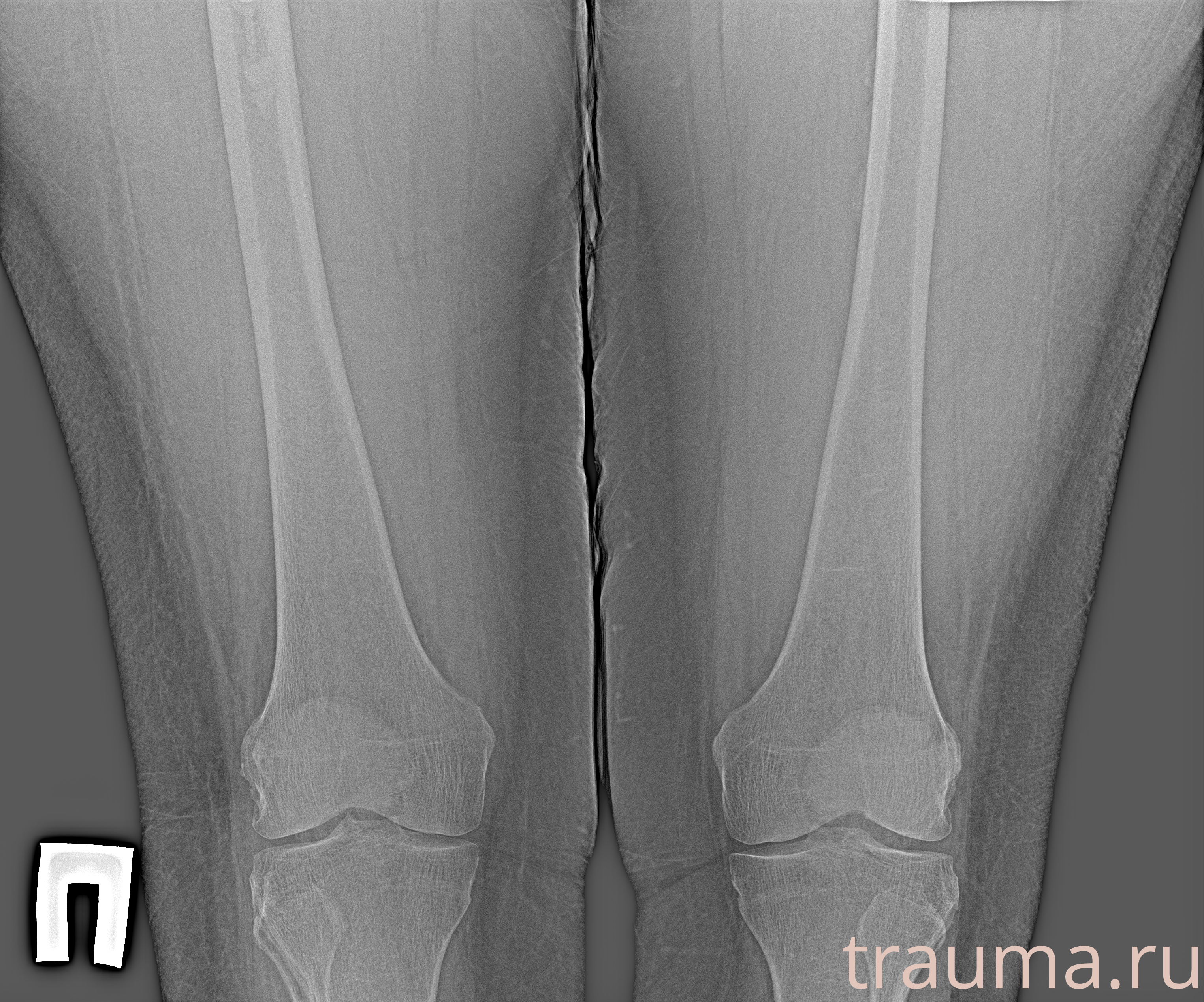 Рентген на дому: по вашему адресу приезжает врач-рентгенолог, травматолог-ортопед с мобильным рентгеновским аппаратом, проводит диагностику травмы или заболевания, делает необходимые рентгенограммы, дает рекомендации по дальнейшему лечению. Получить качественные снимки в домашних условиях возможно благодаря уникальной методике, разработанной МосРентген Центром для института  Склифосовского