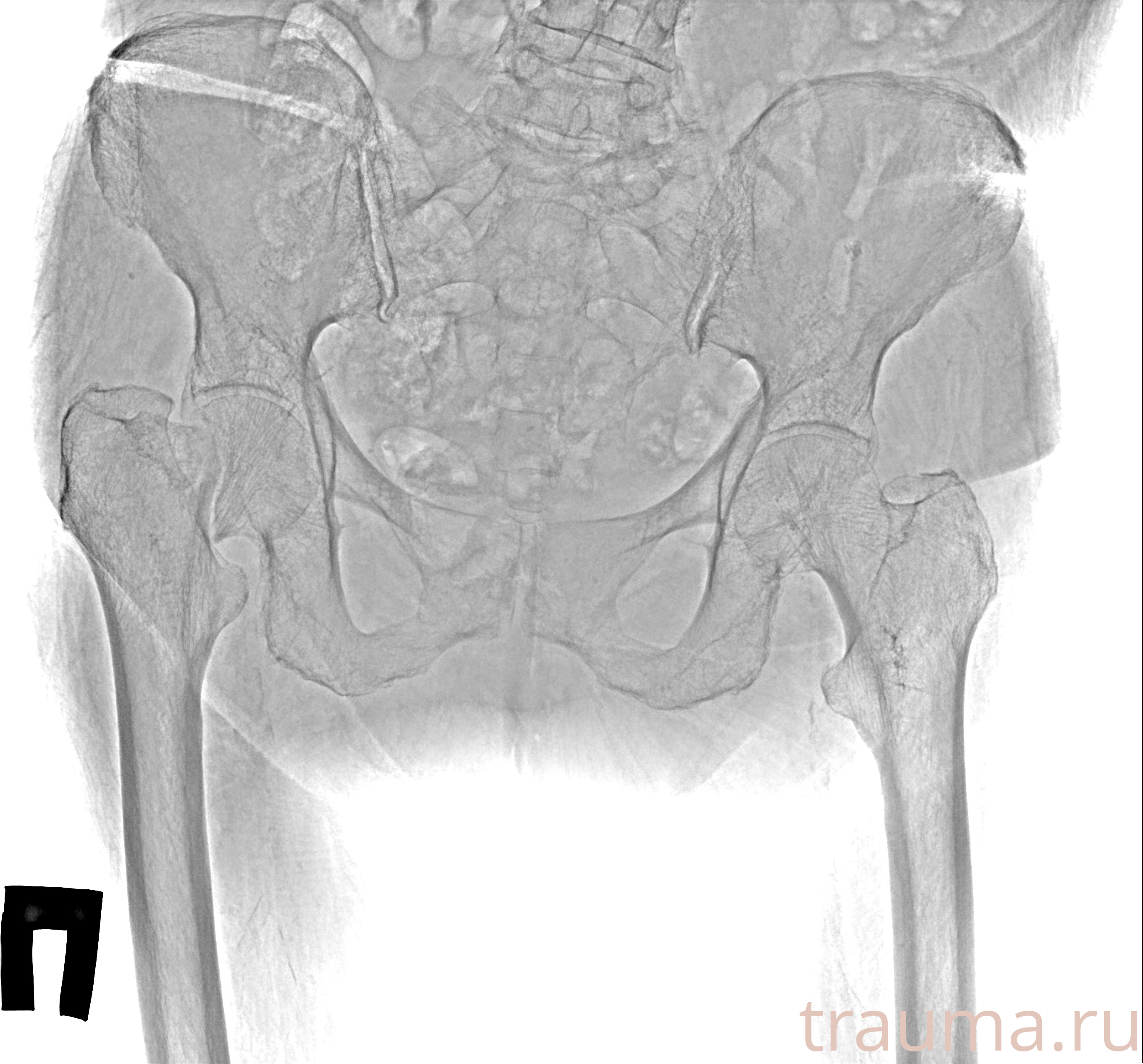 Рентген на дому: по вашему адресу приезжает врач-рентгенолог, травматолог-ортопед с мобильным рентгеновским аппаратом, проводит диагностику травмы или заболевания, делает необходимые рентгенограммы, дает рекомендации по дальнейшему лечению. Получить качественные снимки в домашних условиях возможно благодаря уникальной методике, разработанной МосРентген Центром для института  Склифосовского