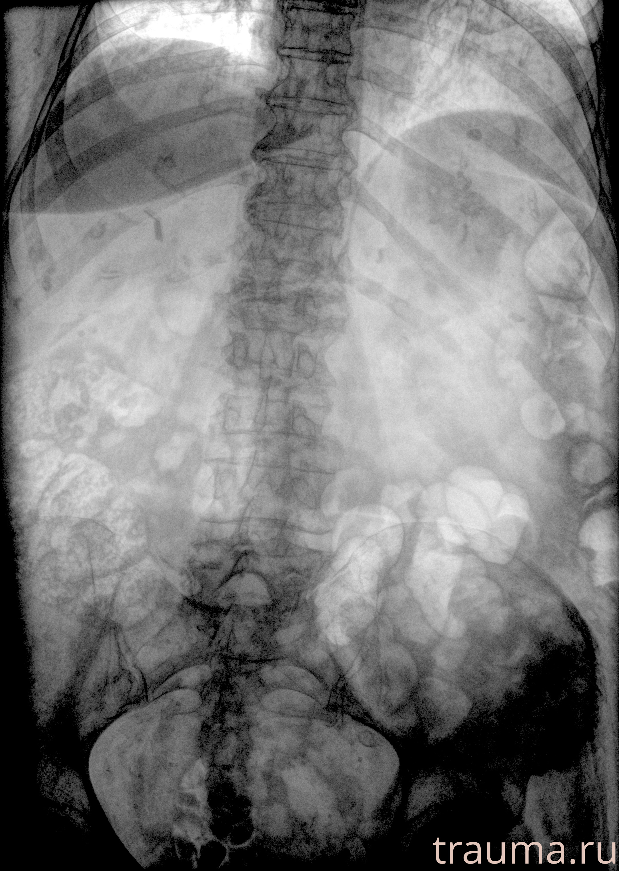 Рентген на дому: по вашему адресу приезжает врач-рентгенолог, травматолог-ортопед с мобильным рентгеновским аппаратом, проводит диагностику травмы или заболевания, делает необходимые рентгенограммы, дает рекомендации по дальнейшему лечению. Получить качественные снимки в домашних условиях возможно благодаря уникальной методике, разработанной МосРентген Центром для института  Склифосовского