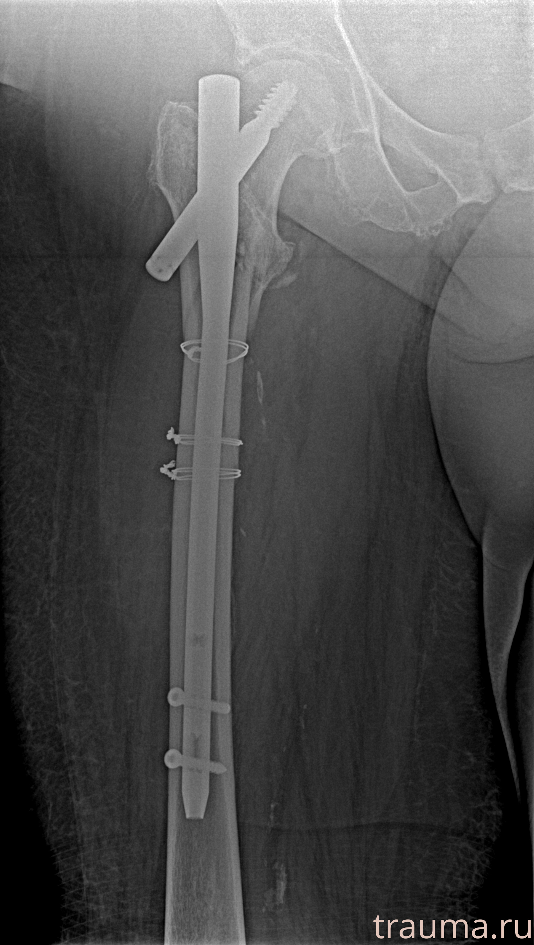 Рентген на дому: по вашему адресу приезжает врач-рентгенолог, травматолог-ортопед с мобильным рентгеновским аппаратом, проводит диагностику травмы или заболевания, делает необходимые рентгенограммы, дает рекомендации по дальнейшему лечению. Получить качественные снимки в домашних условиях возможно благодаря уникальной методике, разработанной МосРентген Центром для института  Склифосовского
