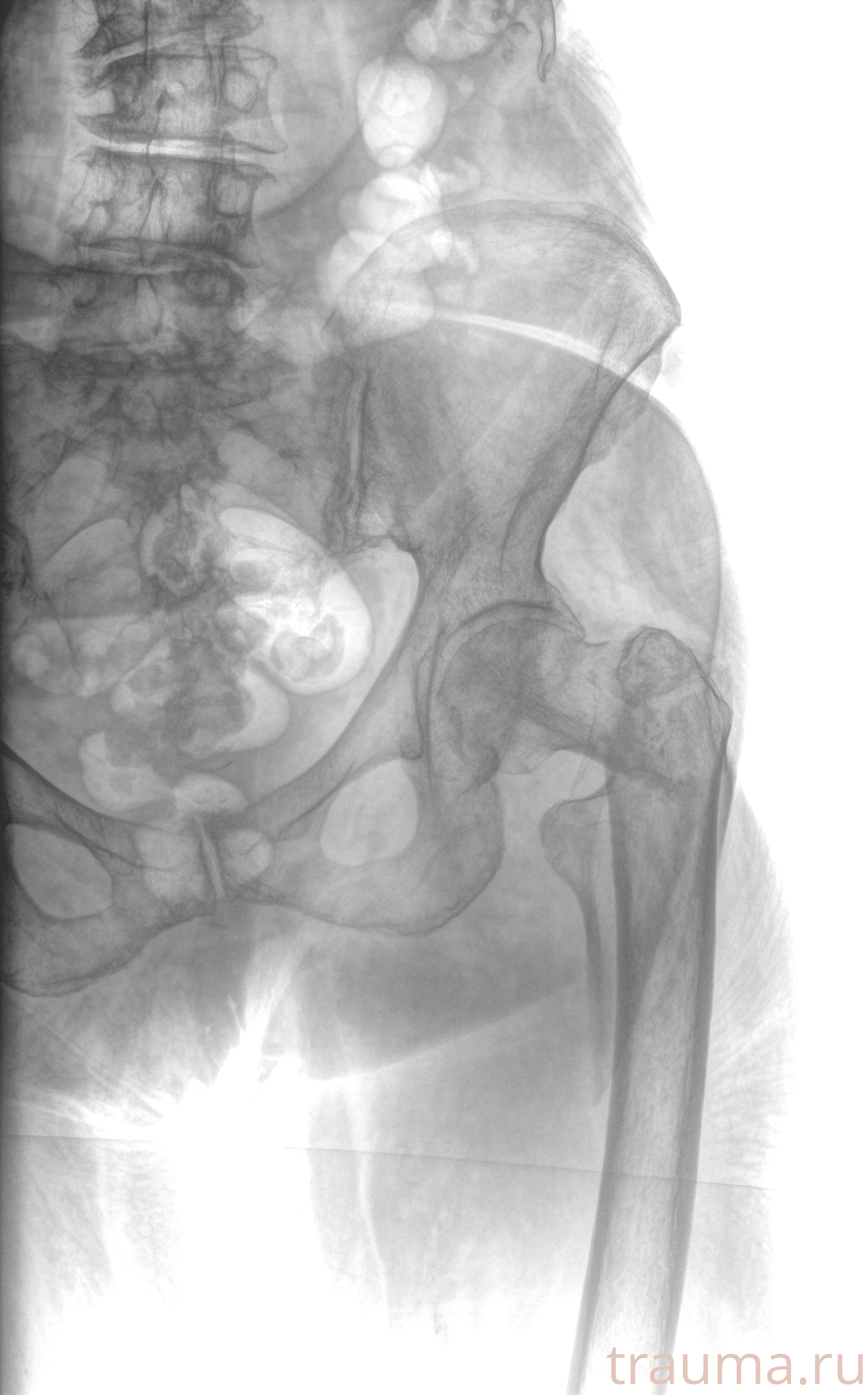 Рентген на дому: по вашему адресу приезжает врач-рентгенолог, травматолог-ортопед с мобильным рентгеновским аппаратом, проводит диагностику травмы или заболевания, делает необходимые рентгенограммы, дает рекомендации по дальнейшему лечению. Получить качественные снимки в домашних условиях возможно благодаря уникальной методике, разработанной МосРентген Центром для института  Склифосовского