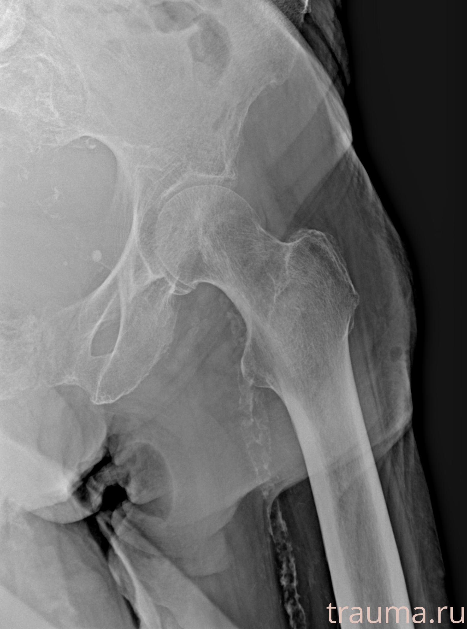 Рентген на дому: по вашему адресу приезжает врач-рентгенолог, травматолог-ортопед с мобильным рентгеновским аппаратом, проводит диагностику травмы или заболевания, делает необходимые рентгенограммы, дает рекомендации по дальнейшему лечению. Получить качественные снимки в домашних условиях возможно благодаря уникальной методике, разработанной МосРентген Центром для института  Склифосовского