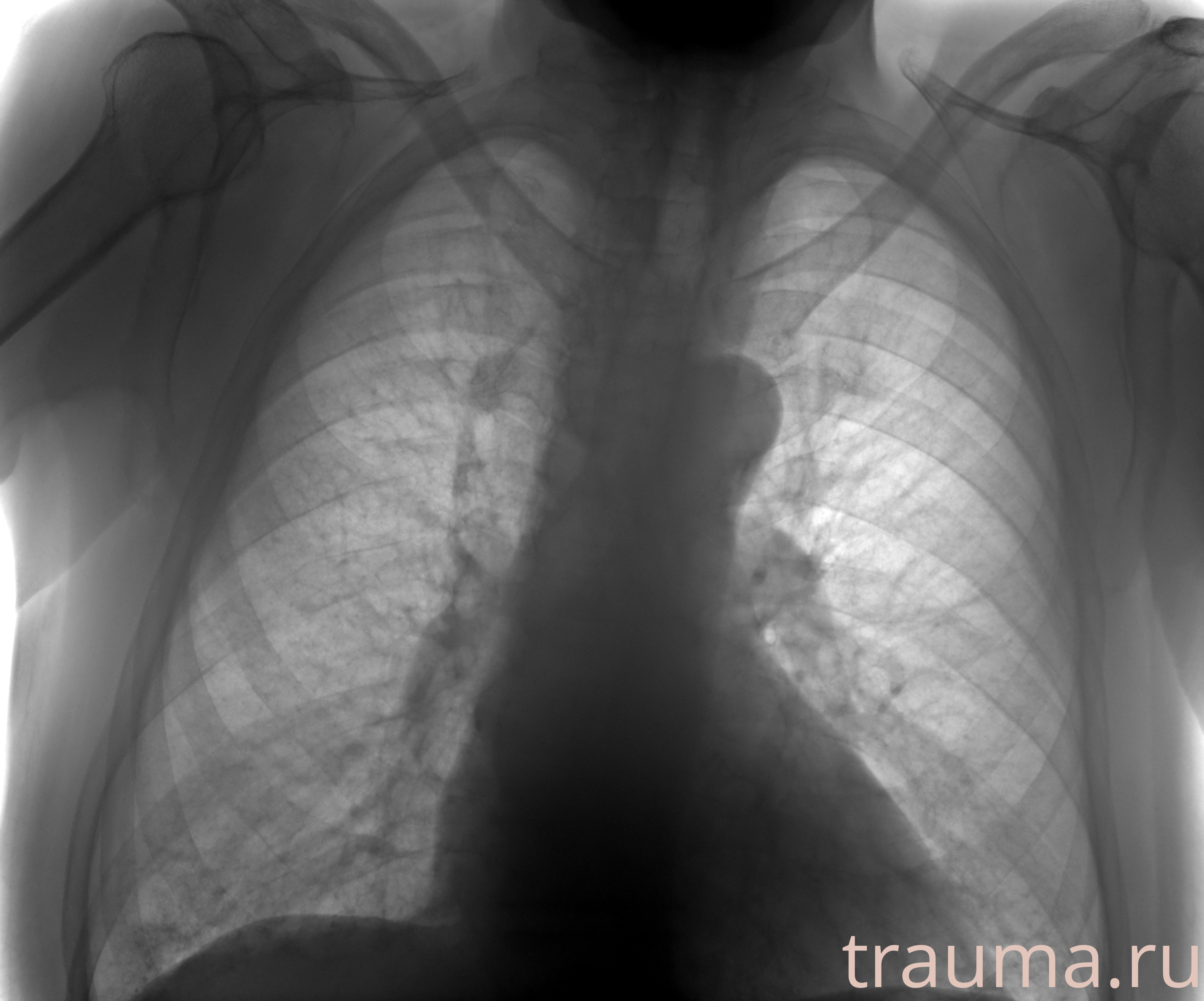 Рентген на дому: по вашему адресу приезжает врач-рентгенолог, травматолог-ортопед с мобильным рентгеновским аппаратом, проводит диагностику травмы или заболевания, делает необходимые рентгенограммы, дает рекомендации по дальнейшему лечению. Получить качественные снимки в домашних условиях возможно благодаря уникальной методике, разработанной МосРентген Центром для института  Склифосовского