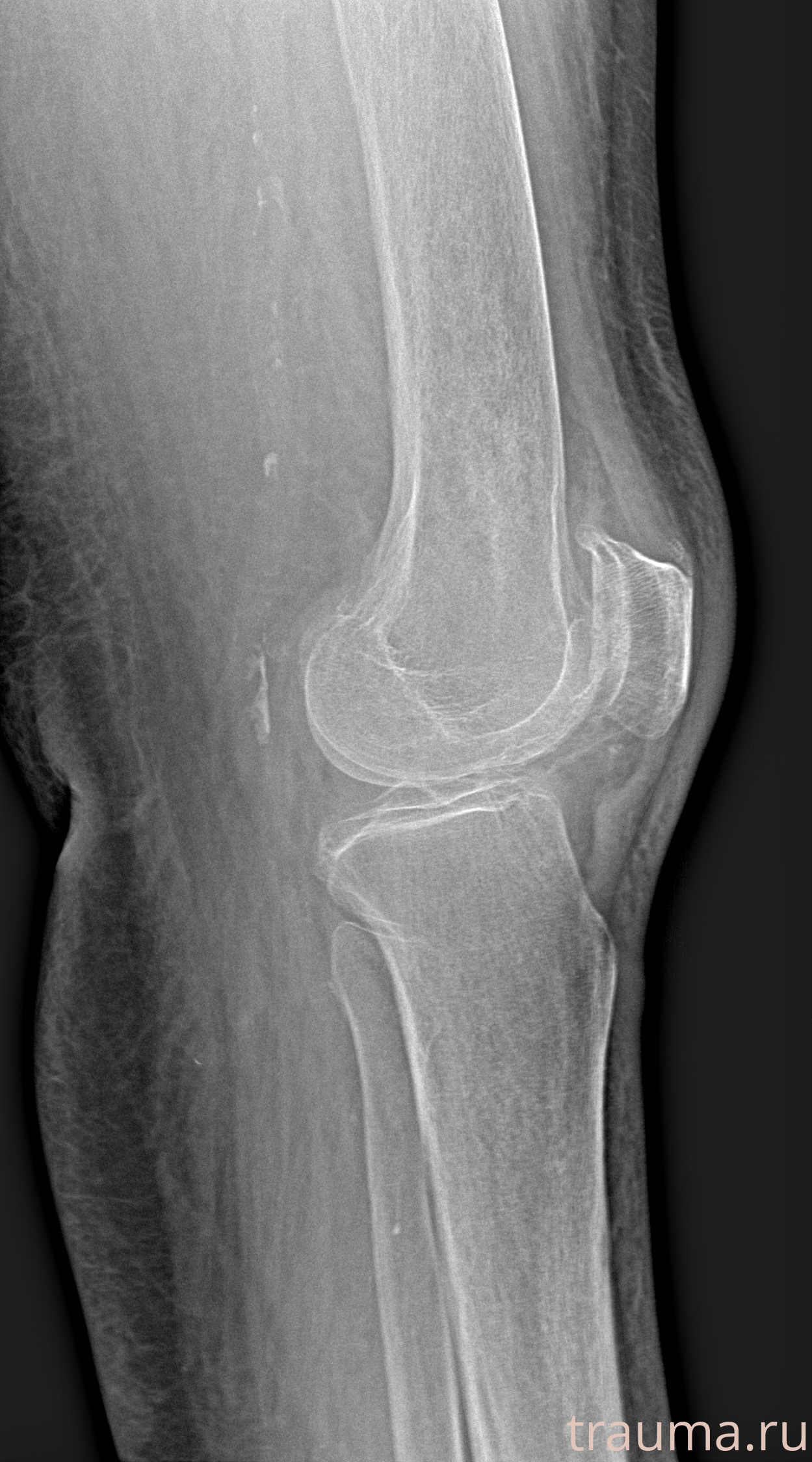 Рентген на дому: по вашему адресу приезжает врач-рентгенолог, травматолог-ортопед с мобильным рентгеновским аппаратом, проводит диагностику травмы или заболевания, делает необходимые рентгенограммы, дает рекомендации по дальнейшему лечению. Получить качественные снимки в домашних условиях возможно благодаря уникальной методике, разработанной МосРентген Центром для института  Склифосовского