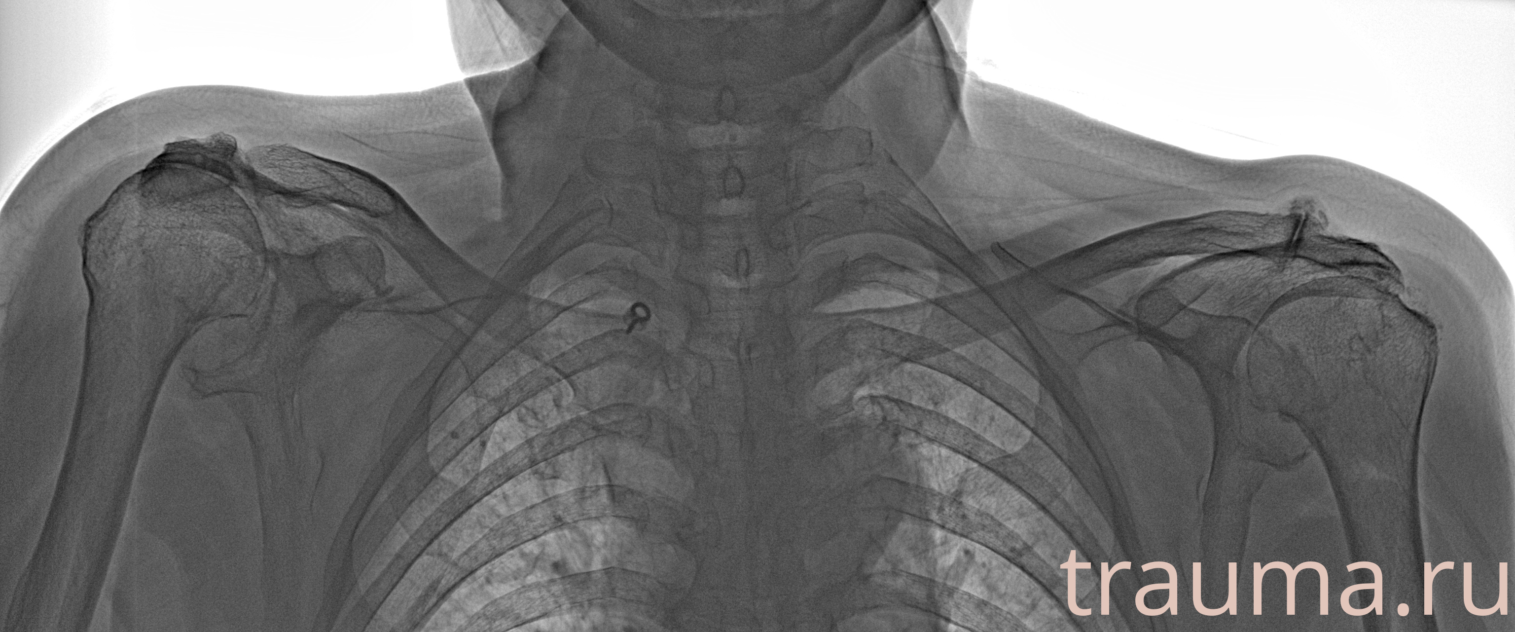 Рентген на дому: по вашему адресу приезжает врач-рентгенолог, травматолог-ортопед с мобильным рентгеновским аппаратом, проводит диагностику травмы или заболевания, делает необходимые рентгенограммы, дает рекомендации по дальнейшему лечению. Получить качественные снимки в домашних условиях возможно благодаря уникальной методике, разработанной МосРентген Центром для института  Склифосовского
