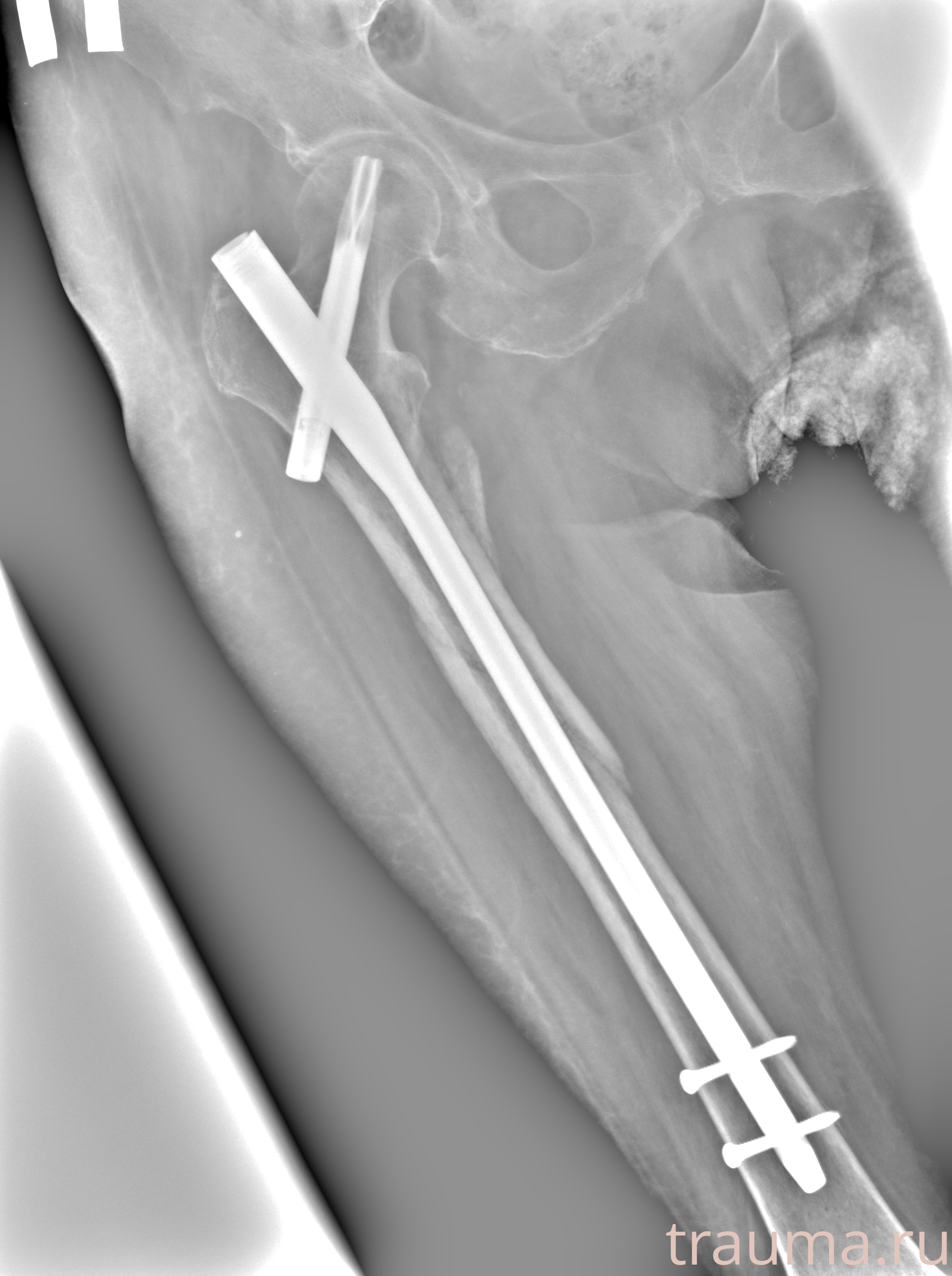 Рентген на дому: по вашему адресу приезжает врач-рентгенолог, травматолог-ортопед с мобильным рентгеновским аппаратом, проводит диагностику травмы или заболевания, делает необходимые рентгенограммы, дает рекомендации по дальнейшему лечению. Получить качественные снимки в домашних условиях возможно благодаря уникальной методике, разработанной МосРентген Центром для института  Склифосовского