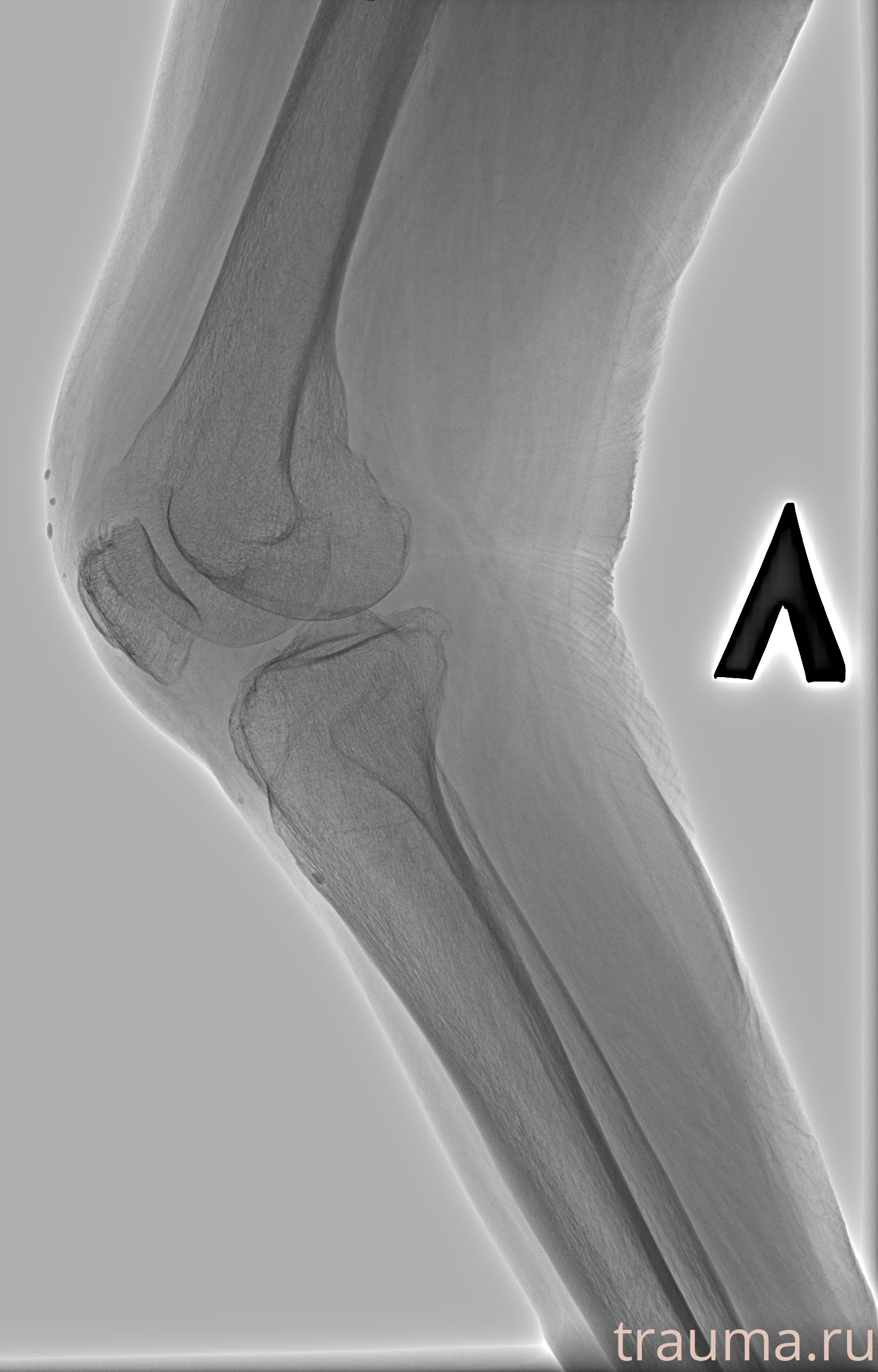 Рентген на дому: по вашему адресу приезжает врач-рентгенолог, травматолог-ортопед с мобильным рентгеновским аппаратом, проводит диагностику травмы или заболевания, делает необходимые рентгенограммы, дает рекомендации по дальнейшему лечению. Получить качественные снимки в домашних условиях возможно благодаря уникальной методике, разработанной МосРентген Центром для института  Склифосовского