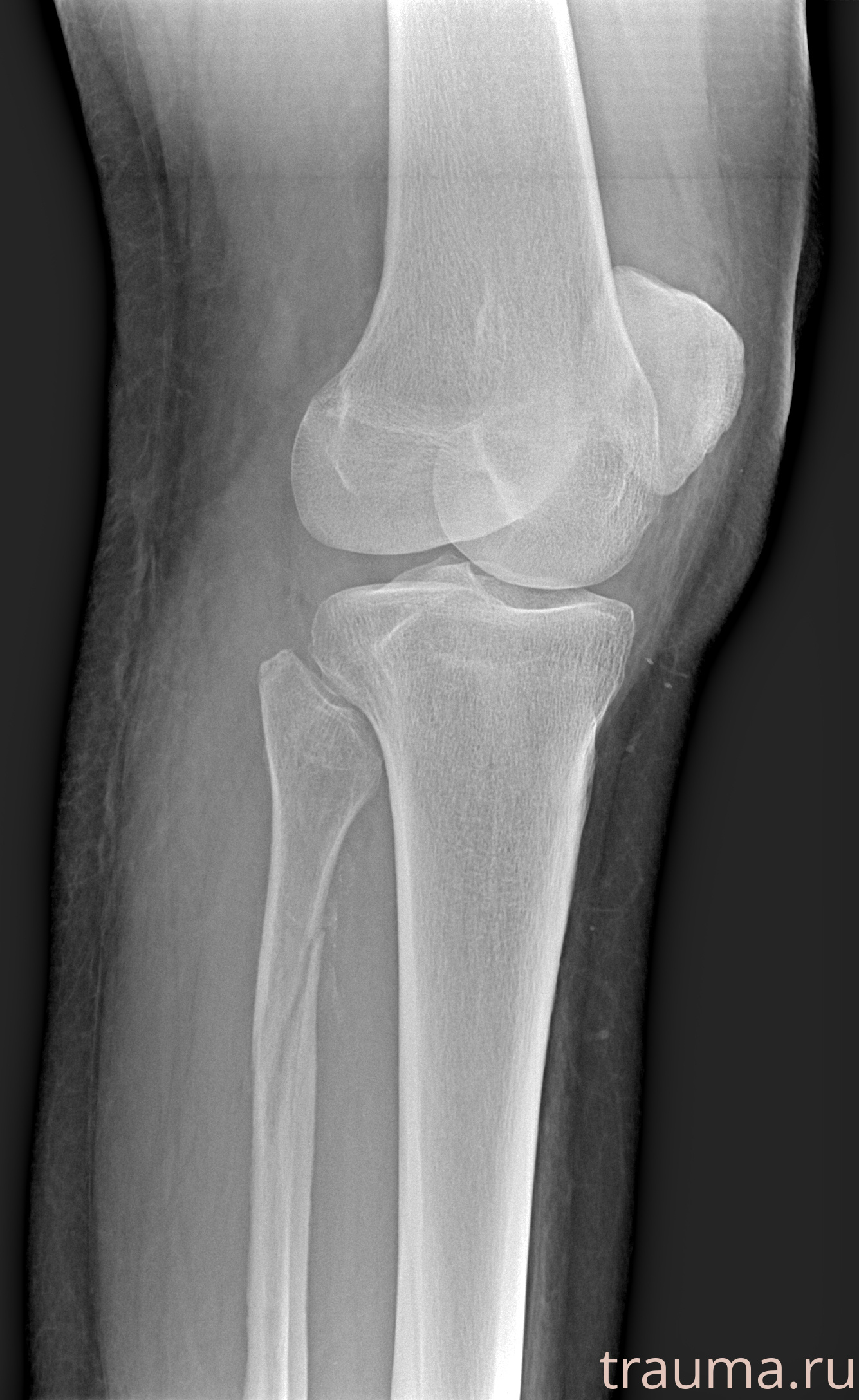 Рентген на дому: по вашему адресу приезжает врач-рентгенолог, травматолог-ортопед с мобильным рентгеновским аппаратом, проводит диагностику травмы или заболевания, делает необходимые рентгенограммы, дает рекомендации по дальнейшему лечению. Получить качественные снимки в домашних условиях возможно благодаря уникальной методике, разработанной МосРентген Центром для института  Склифосовского
