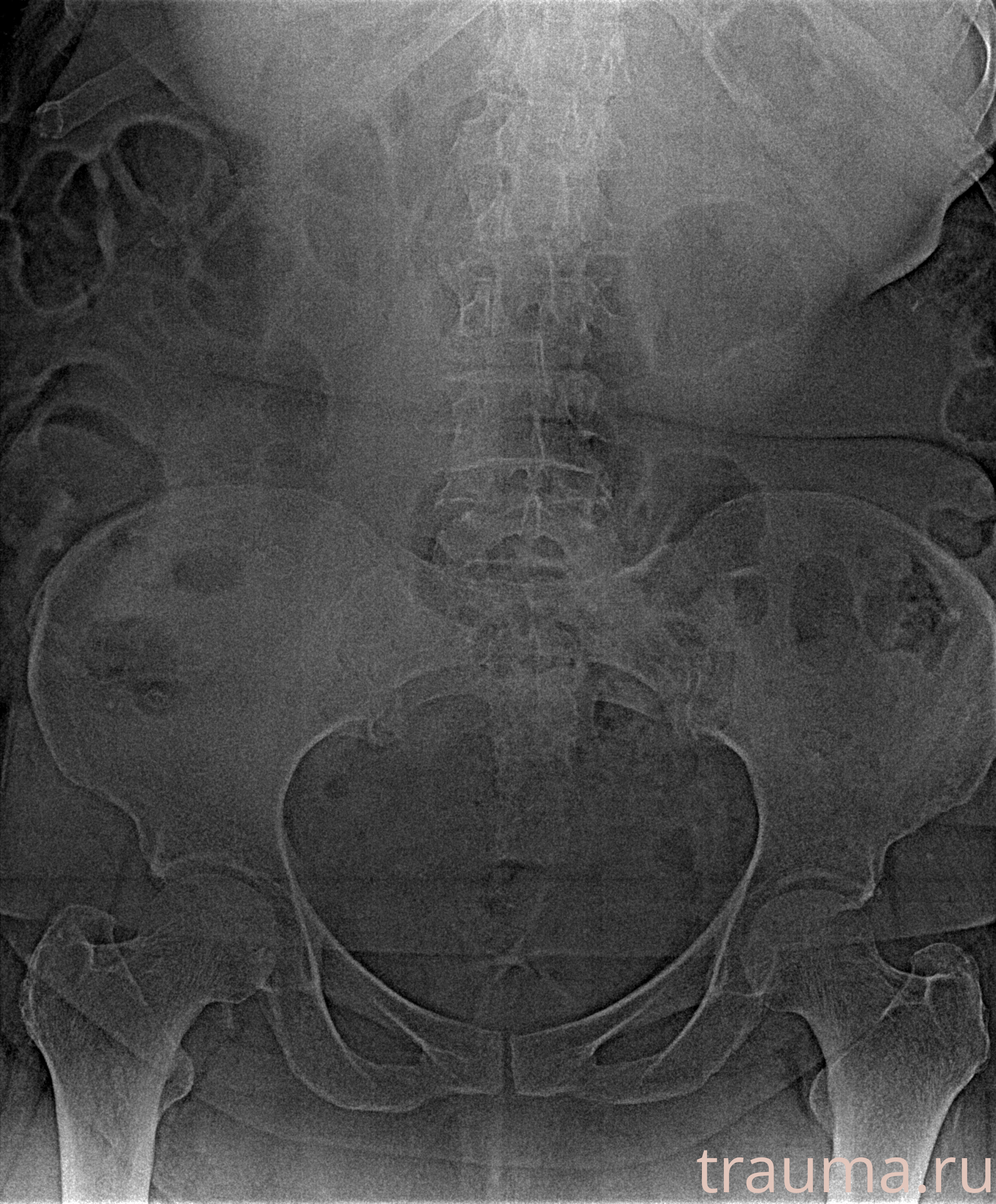 Рентген на дому: по вашему адресу приезжает врач-рентгенолог, травматолог-ортопед с мобильным рентгеновским аппаратом, проводит диагностику травмы или заболевания, делает необходимые рентгенограммы, дает рекомендации по дальнейшему лечению. Получить качественные снимки в домашних условиях возможно благодаря уникальной методике, разработанной МосРентген Центром для института  Склифосовского