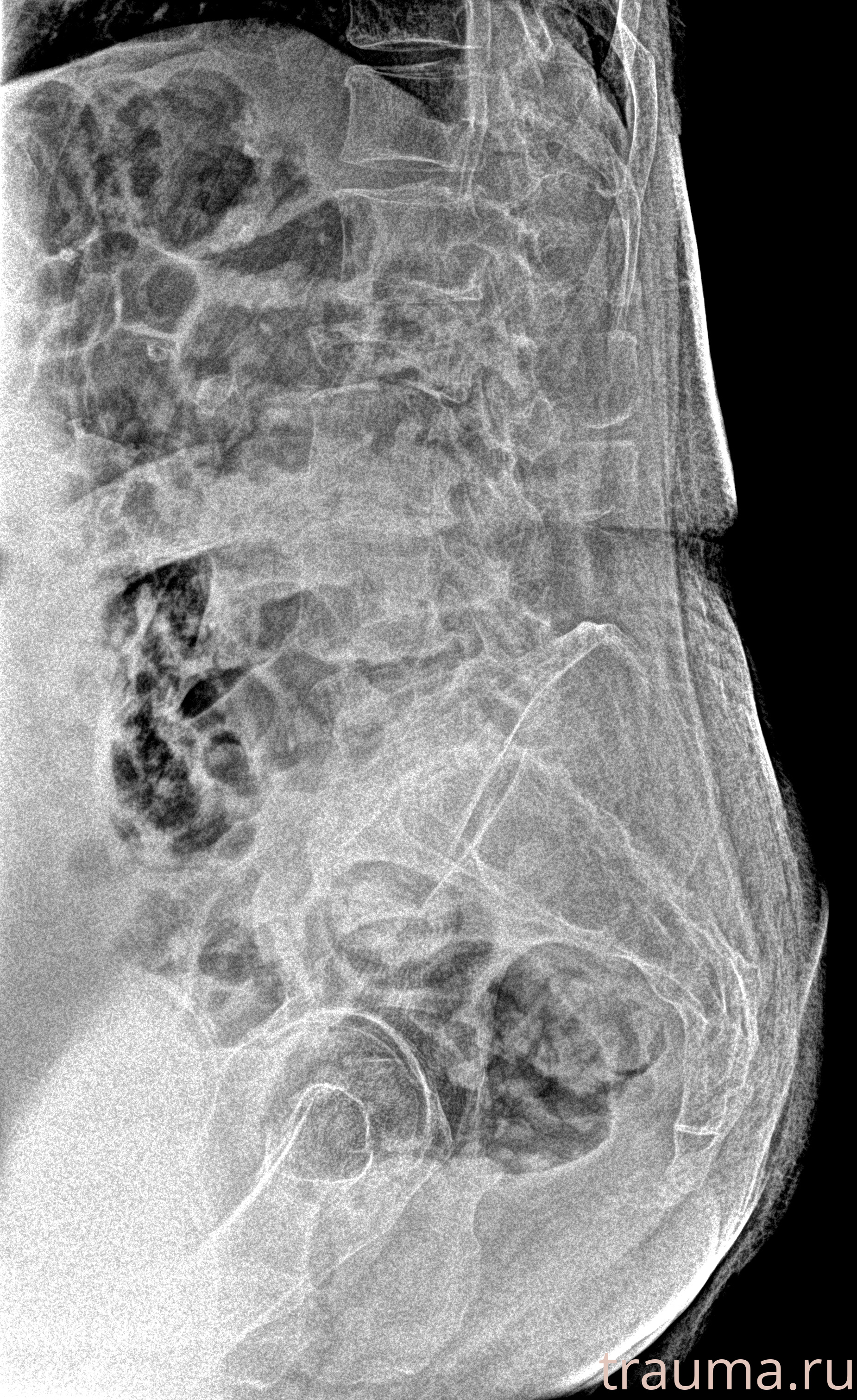 Рентген на дому: по вашему адресу приезжает врач-рентгенолог, травматолог-ортопед с мобильным рентгеновским аппаратом, проводит диагностику травмы или заболевания, делает необходимые рентгенограммы, дает рекомендации по дальнейшему лечению. Получить качественные снимки в домашних условиях возможно благодаря уникальной методике, разработанной МосРентген Центром для института  Склифосовского