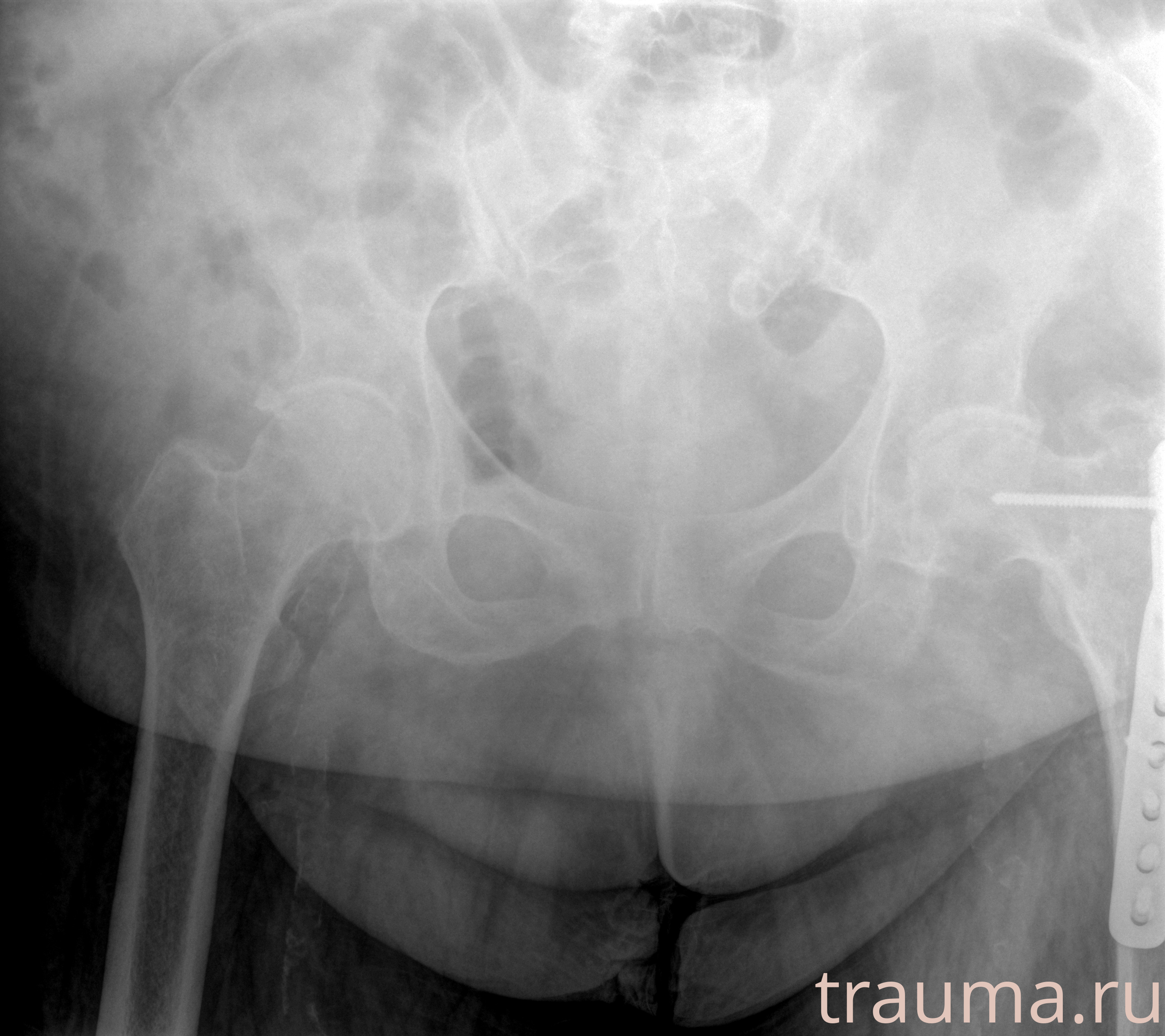 Рентген на дому: по вашему адресу приезжает врач-рентгенолог, травматолог-ортопед с мобильным рентгеновским аппаратом, проводит диагностику травмы или заболевания, делает необходимые рентгенограммы, дает рекомендации по дальнейшему лечению. Получить качественные снимки в домашних условиях возможно благодаря уникальной методике, разработанной МосРентген Центром для института  Склифосовского