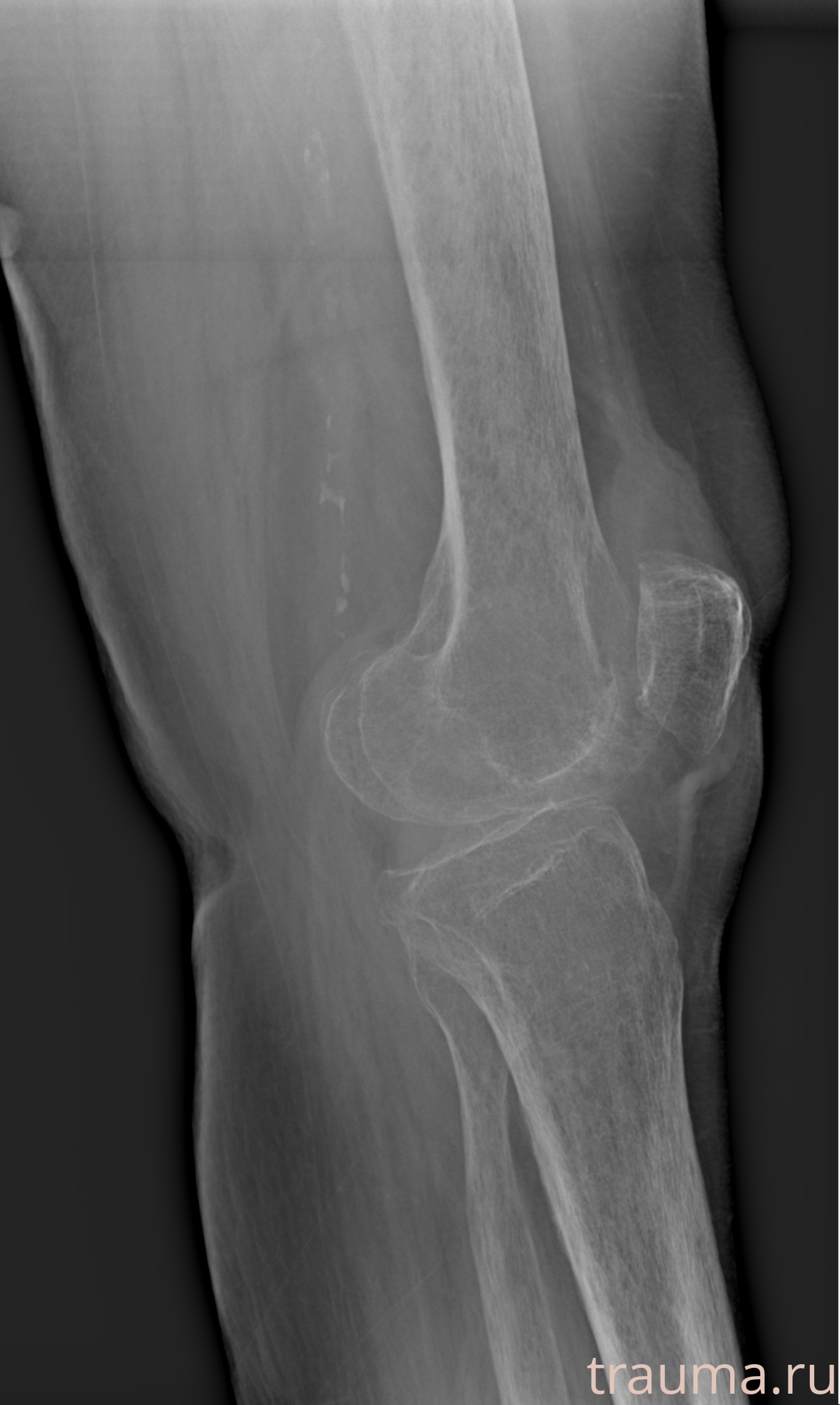 Рентген на дому: по вашему адресу приезжает врач-рентгенолог, травматолог-ортопед с мобильным рентгеновским аппаратом, проводит диагностику травмы или заболевания, делает необходимые рентгенограммы, дает рекомендации по дальнейшему лечению. Получить качественные снимки в домашних условиях возможно благодаря уникальной методике, разработанной МосРентген Центром для института  Склифосовского