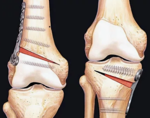 Хирургическое лечение деформирующего остеоартроза коленного сустава