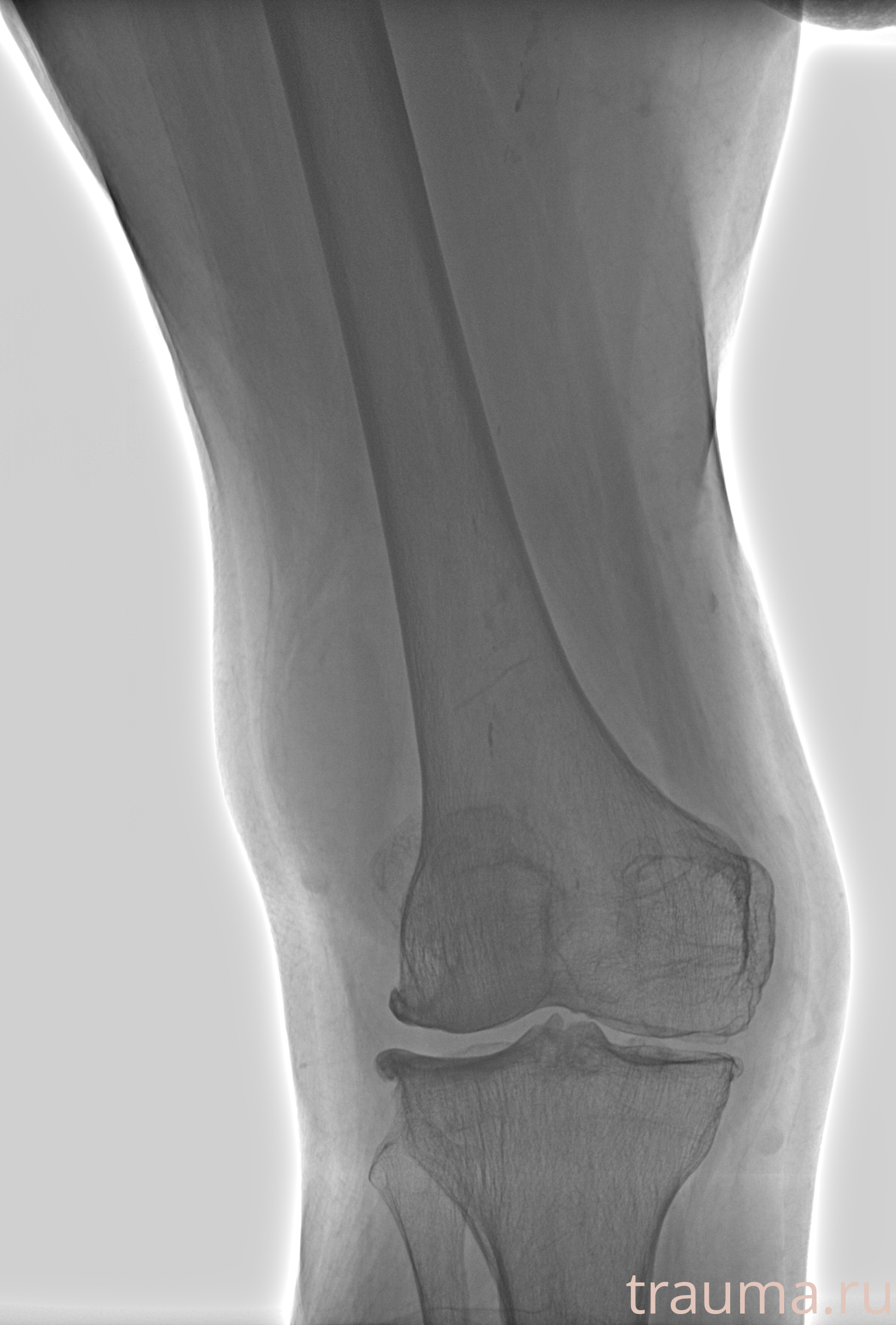 Рентген на дому: по вашему адресу приезжает врач-рентгенолог, травматолог-ортопед с мобильным рентгеновским аппаратом, проводит диагностику травмы или заболевания, делает необходимые рентгенограммы, дает рекомендации по дальнейшему лечению. Получить качественные снимки в домашних условиях возможно благодаря уникальной методике, разработанной МосРентген Центром для института  Склифосовского