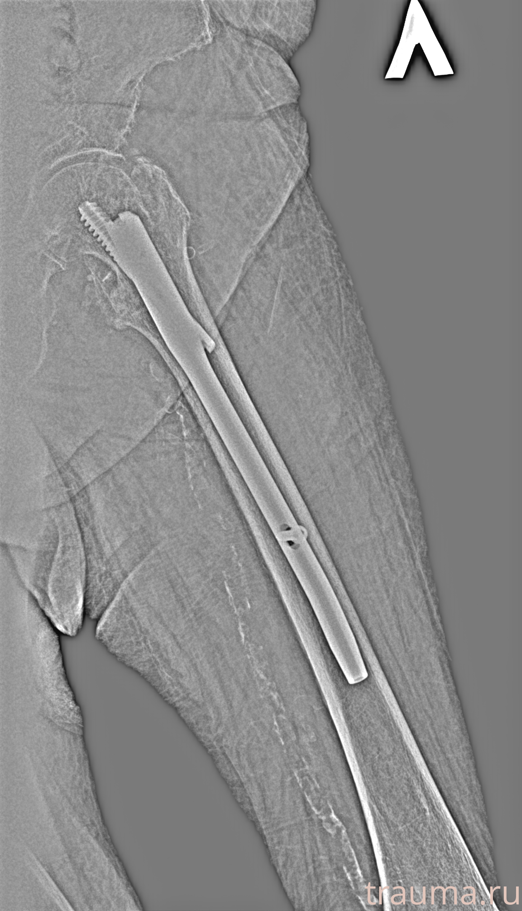 Рентген на дому: по вашему адресу приезжает врач-рентгенолог, травматолог-ортопед с мобильным рентгеновским аппаратом, проводит диагностику травмы или заболевания, делает необходимые рентгенограммы, дает рекомендации по дальнейшему лечению. Получить качественные снимки в домашних условиях возможно благодаря уникальной методике, разработанной МосРентген Центром для института  Склифосовского