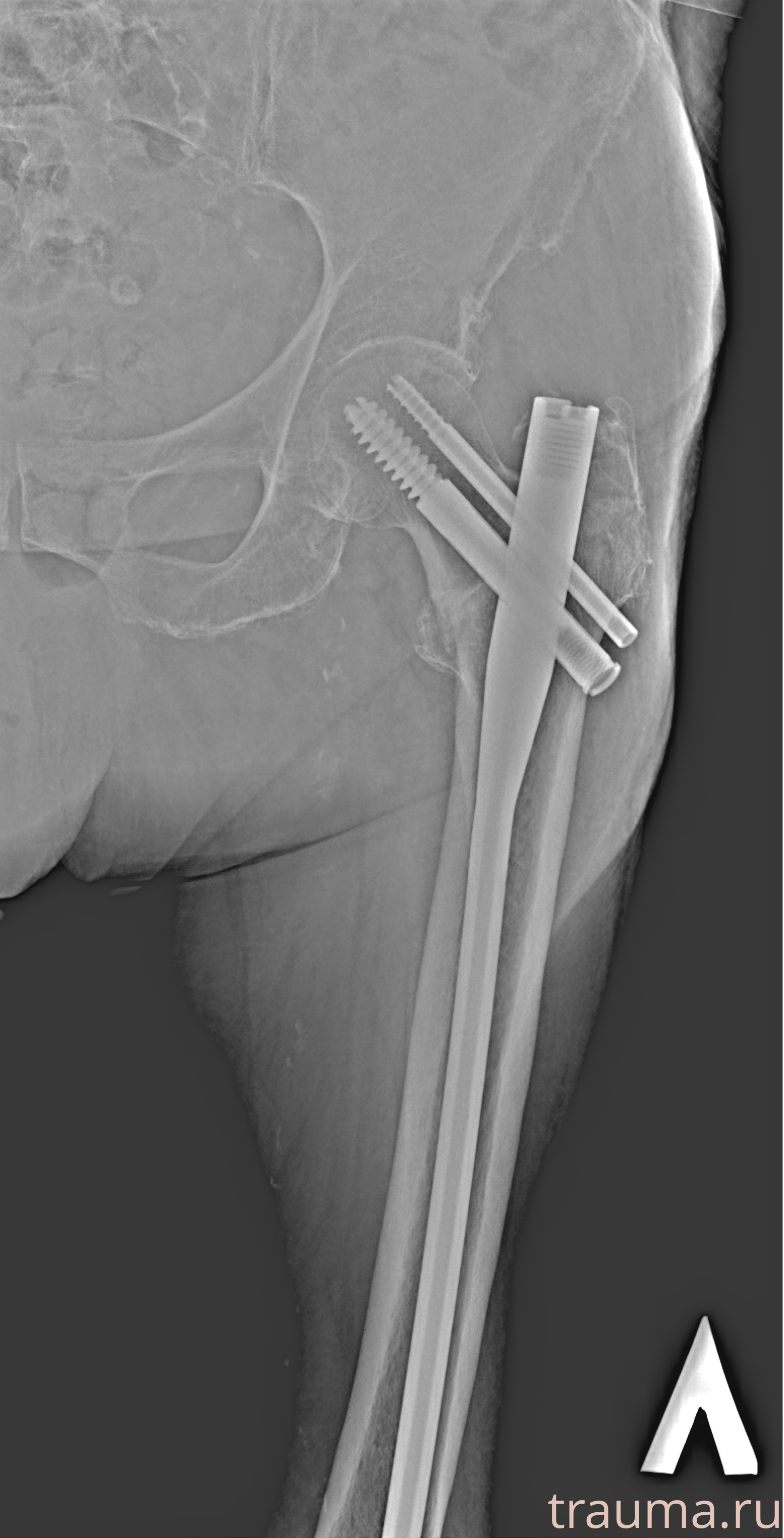 Рентген на дому: по вашему адресу приезжает врач-рентгенолог, травматолог-ортопед с мобильным рентгеновским аппаратом, проводит диагностику травмы или заболевания, делает необходимые рентгенограммы, дает рекомендации по дальнейшему лечению. Получить качественные снимки в домашних условиях возможно благодаря уникальной методике, разработанной МосРентген Центром для института  Склифосовского