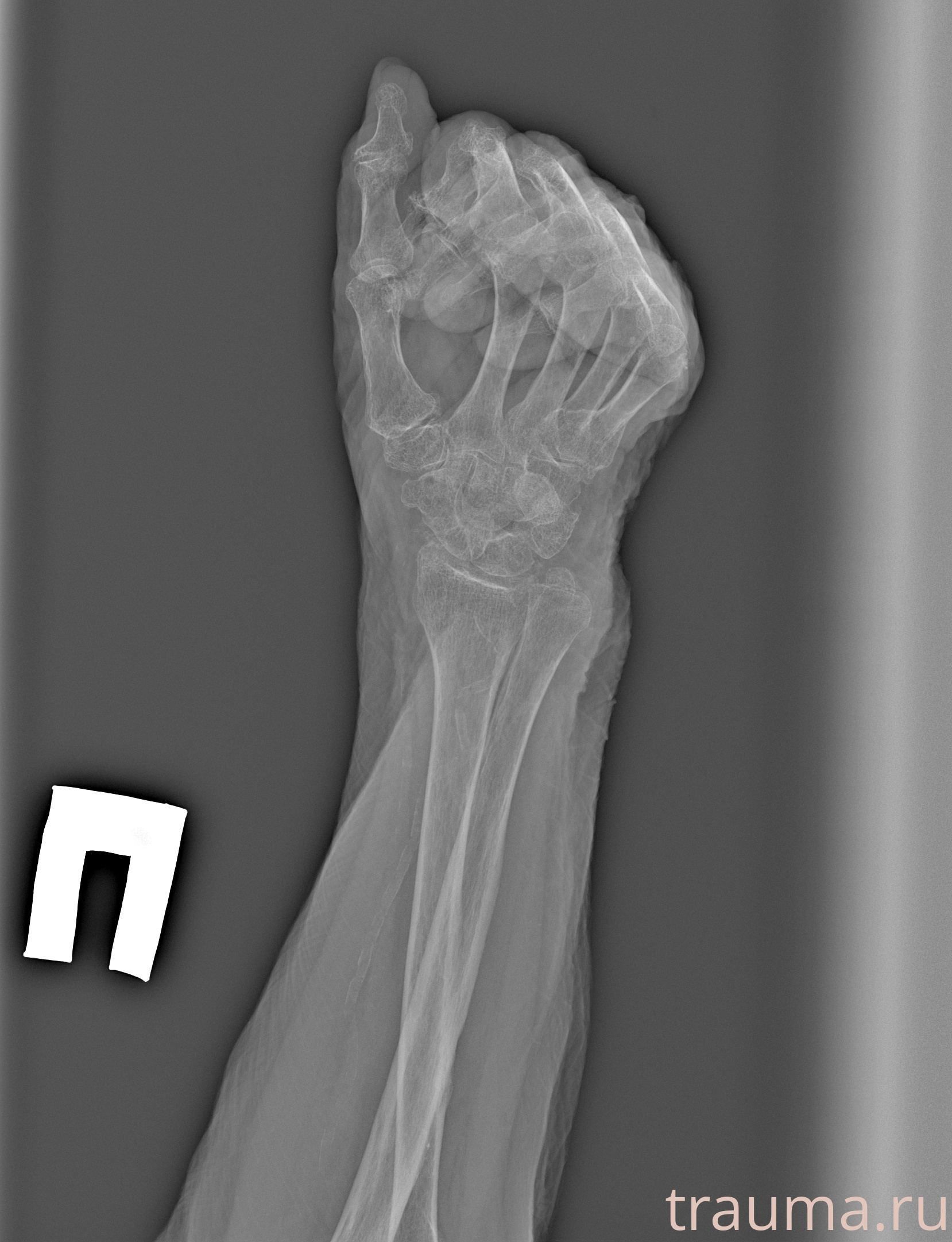 Рентген на дому: по вашему адресу приезжает врач-рентгенолог, травматолог-ортопед с мобильным рентгеновским аппаратом, проводит диагностику травмы или заболевания, делает необходимые рентгенограммы, дает рекомендации по дальнейшему лечению. Получить качественные снимки в домашних условиях возможно благодаря уникальной методике, разработанной МосРентген Центром для института  Склифосовского