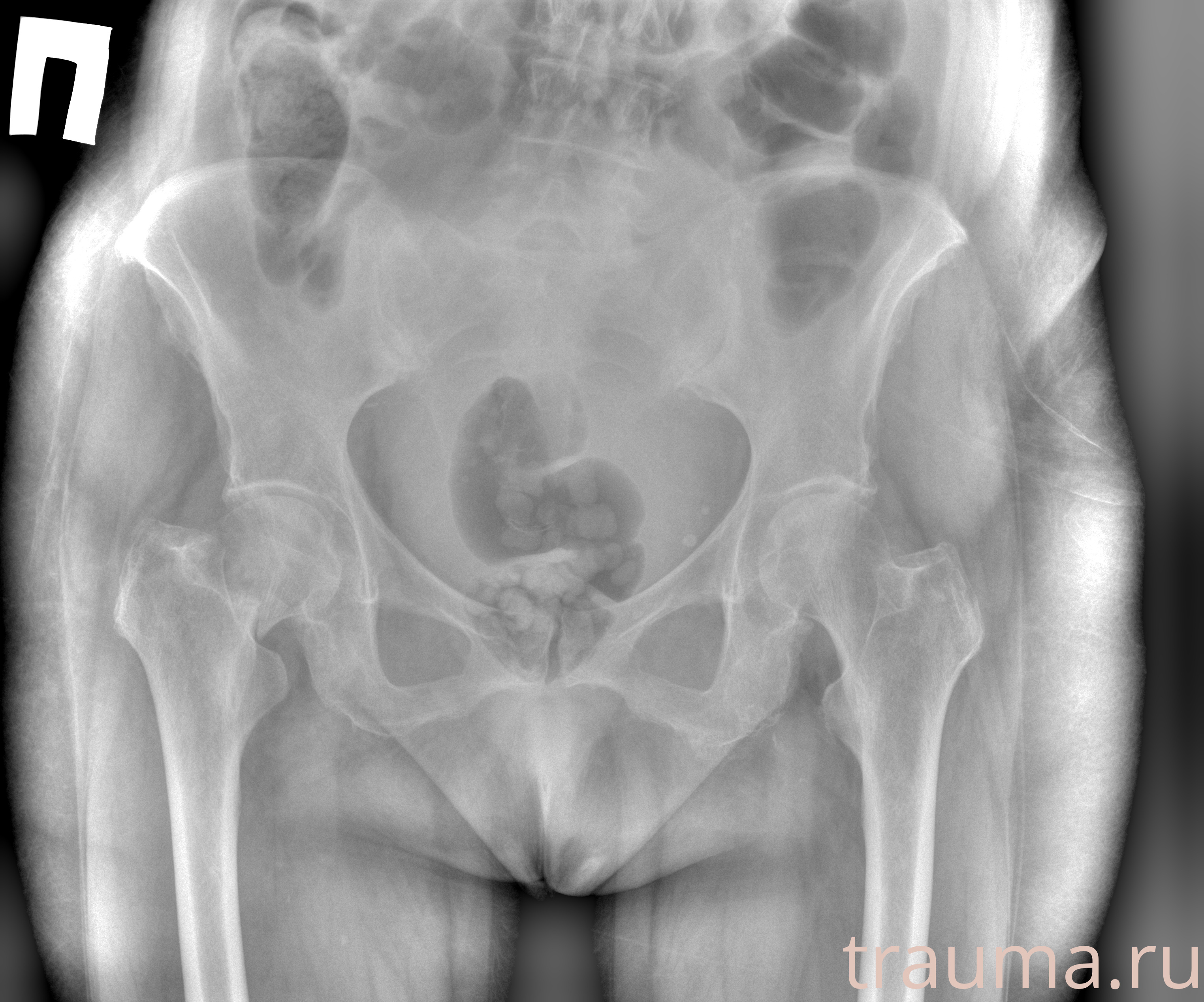 Рентген на дому: по вашему адресу приезжает врач-рентгенолог, травматолог-ортопед с мобильным рентгеновским аппаратом, проводит диагностику травмы или заболевания, делает необходимые рентгенограммы, дает рекомендации по дальнейшему лечению. Получить качественные снимки в домашних условиях возможно благодаря уникальной методике, разработанной МосРентген Центром для института  Склифосовского