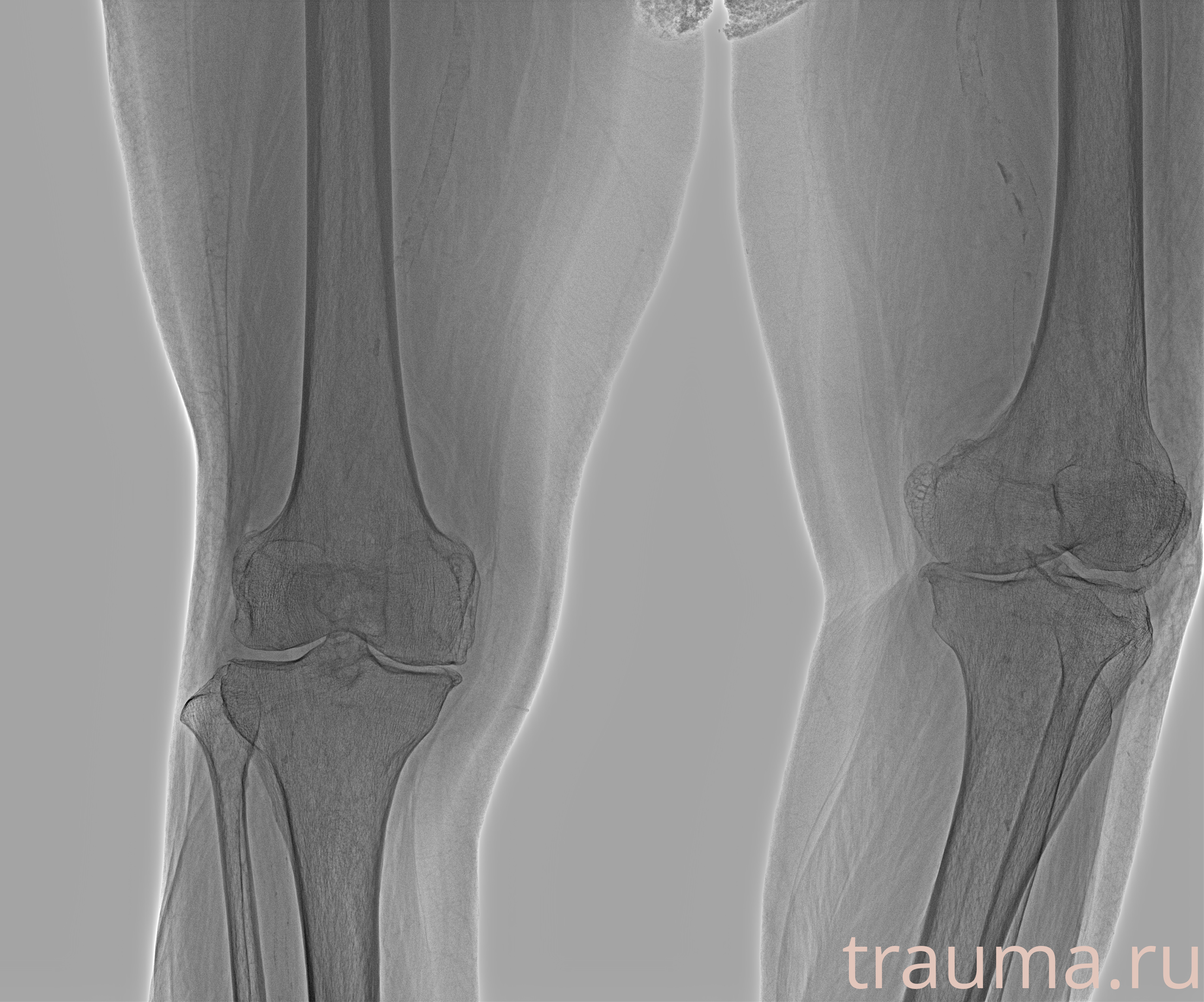 Рентген на дому: по вашему адресу приезжает врач-рентгенолог, травматолог-ортопед с мобильным рентгеновским аппаратом, проводит диагностику травмы или заболевания, делает необходимые рентгенограммы, дает рекомендации по дальнейшему лечению. Получить качественные снимки в домашних условиях возможно благодаря уникальной методике, разработанной МосРентген Центром для института  Склифосовского