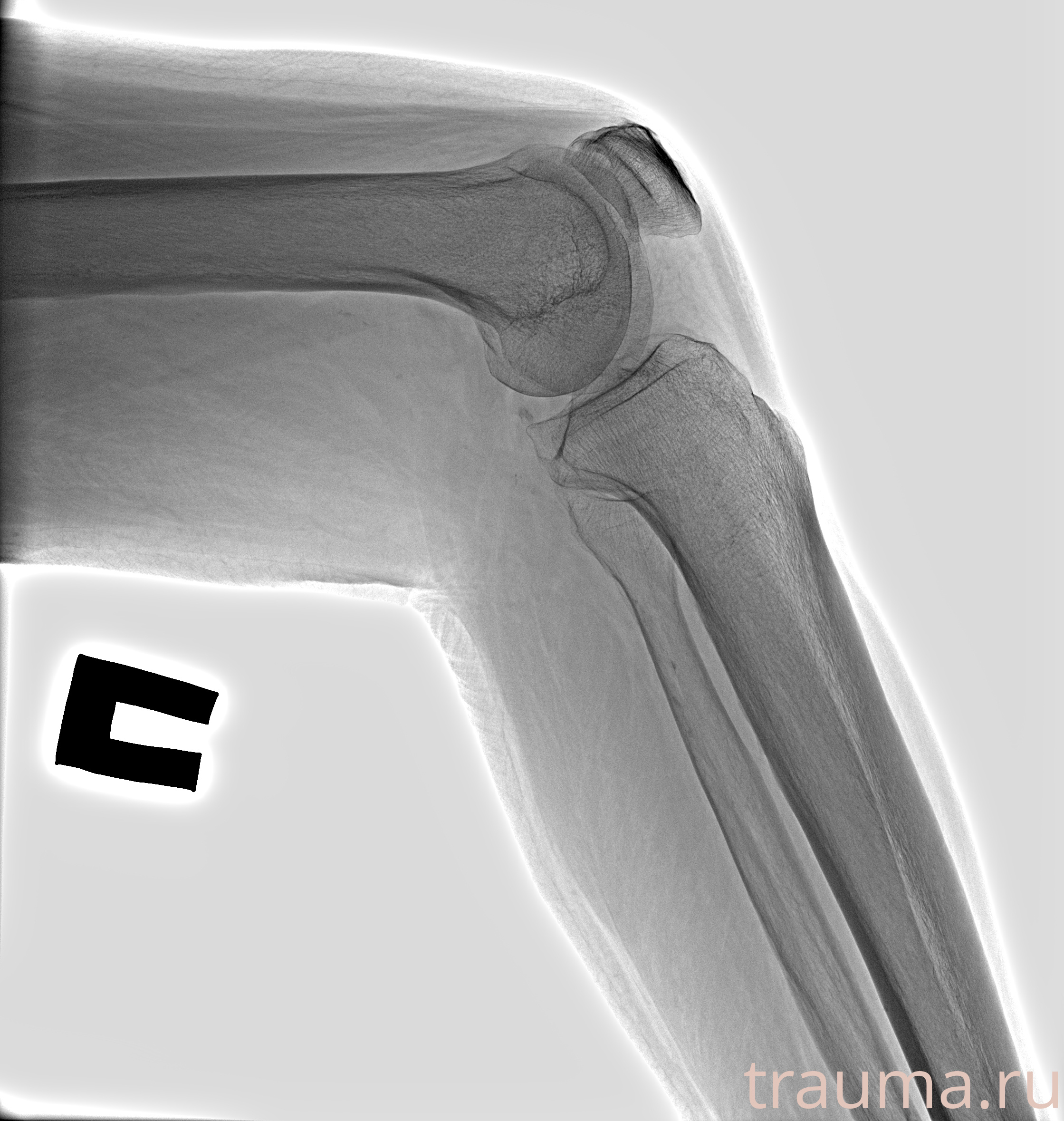 Рентген на дому: по вашему адресу приезжает врач-рентгенолог, травматолог-ортопед с мобильным рентгеновским аппаратом, проводит диагностику травмы или заболевания, делает необходимые рентгенограммы, дает рекомендации по дальнейшему лечению. Получить качественные снимки в домашних условиях возможно благодаря уникальной методике, разработанной МосРентген Центром для института  Склифосовского