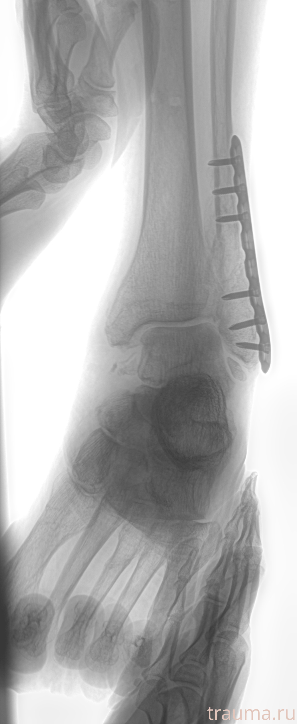 Рентген на дому: по вашему адресу приезжает врач-рентгенолог, травматолог-ортопед с мобильным рентгеновским аппаратом, проводит диагностику травмы или заболевания, делает необходимые рентгенограммы, дает рекомендации по дальнейшему лечению. Получить качественные снимки в домашних условиях возможно благодаря уникальной методике, разработанной МосРентген Центром для института  Склифосовского