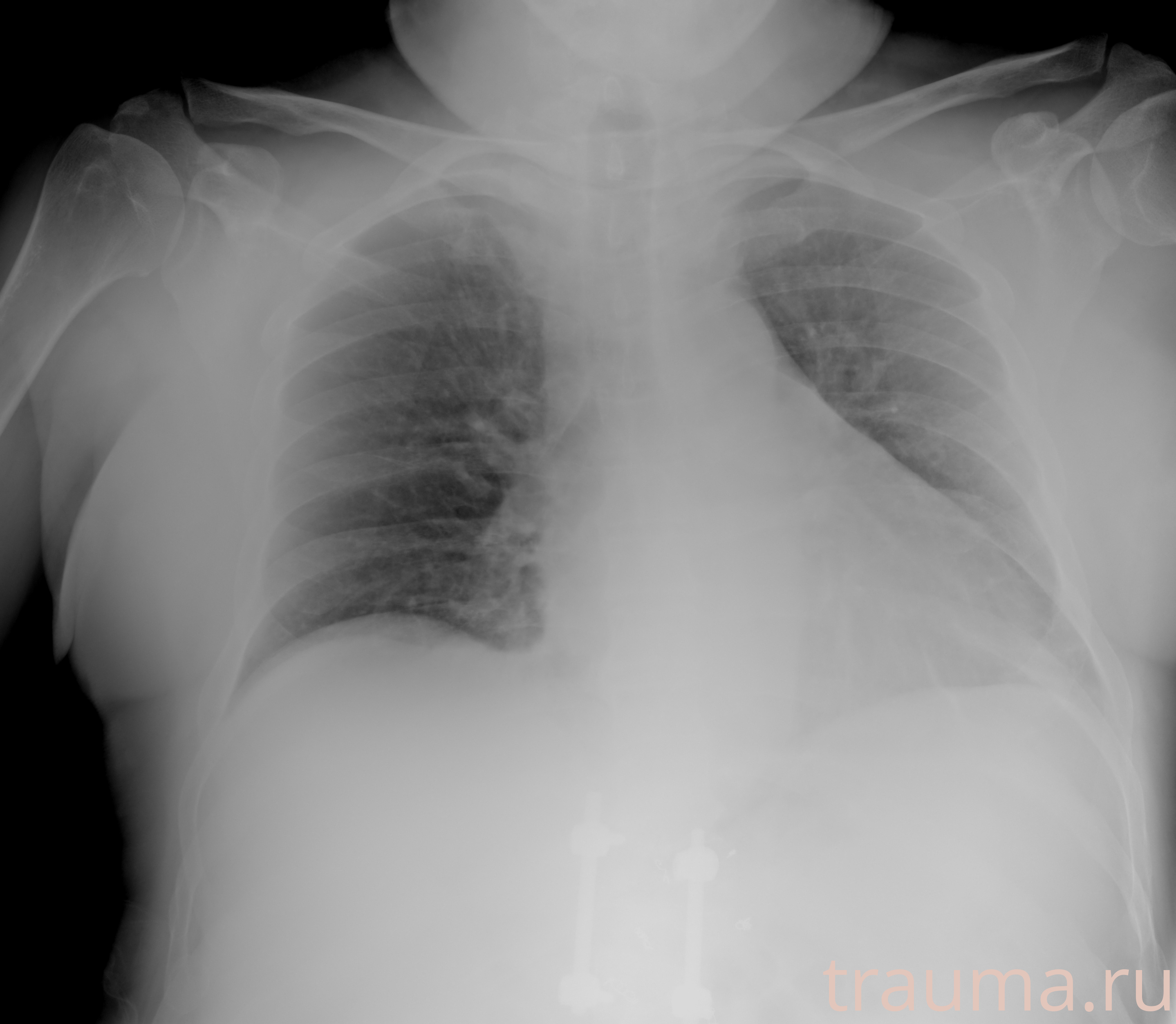 Рентген на дому: по вашему адресу приезжает врач-рентгенолог, травматолог-ортопед с мобильным рентгеновским аппаратом, проводит диагностику травмы или заболевания, делает необходимые рентгенограммы, дает рекомендации по дальнейшему лечению. Получить качественные снимки в домашних условиях возможно благодаря уникальной методике, разработанной МосРентген Центром для института  Склифосовского