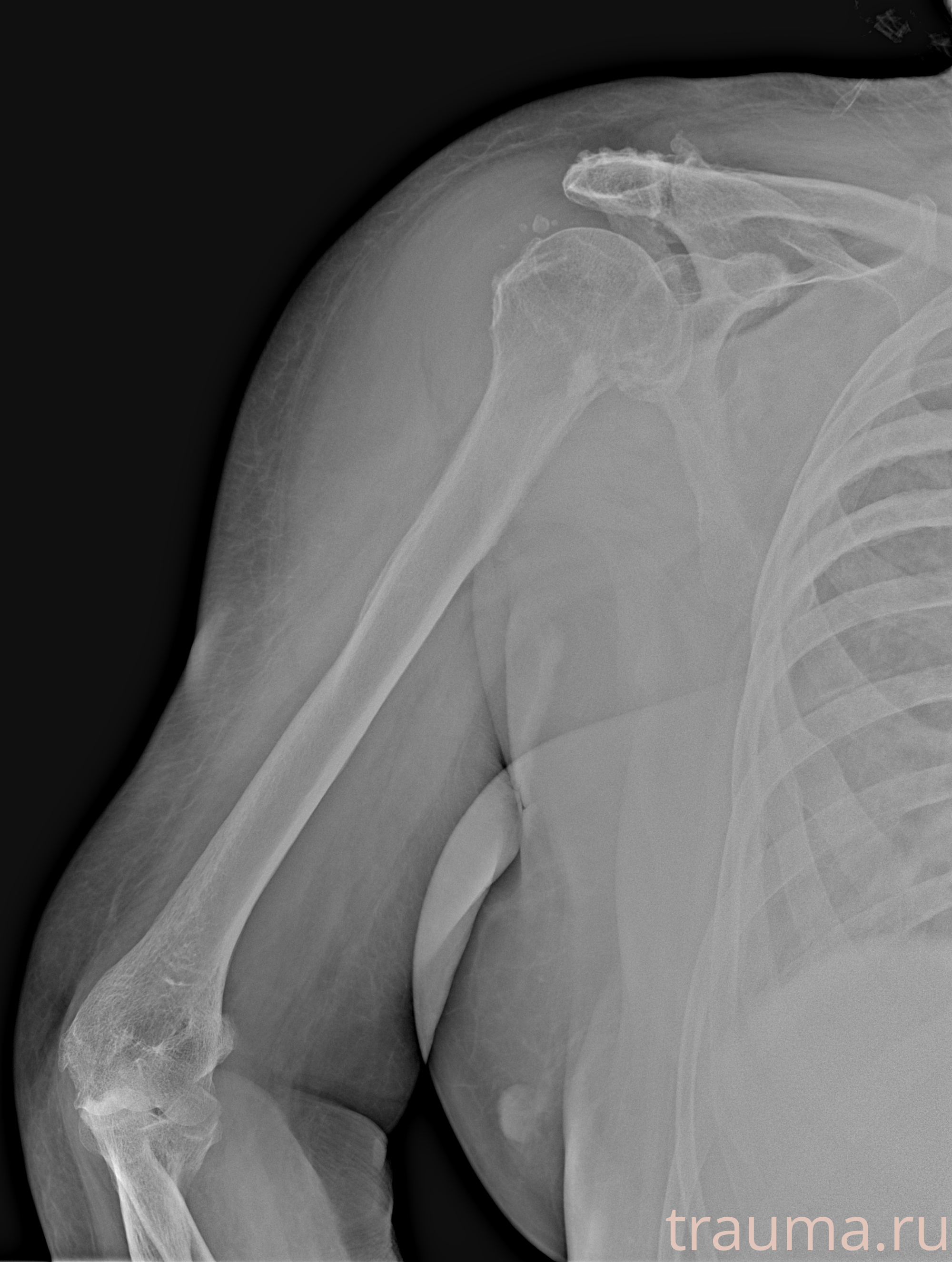 Рентген на дому: по вашему адресу приезжает врач-рентгенолог, травматолог-ортопед с мобильным рентгеновским аппаратом, проводит диагностику травмы или заболевания, делает необходимые рентгенограммы, дает рекомендации по дальнейшему лечению. Получить качественные снимки в домашних условиях возможно благодаря уникальной методике, разработанной МосРентген Центром для института  Склифосовского