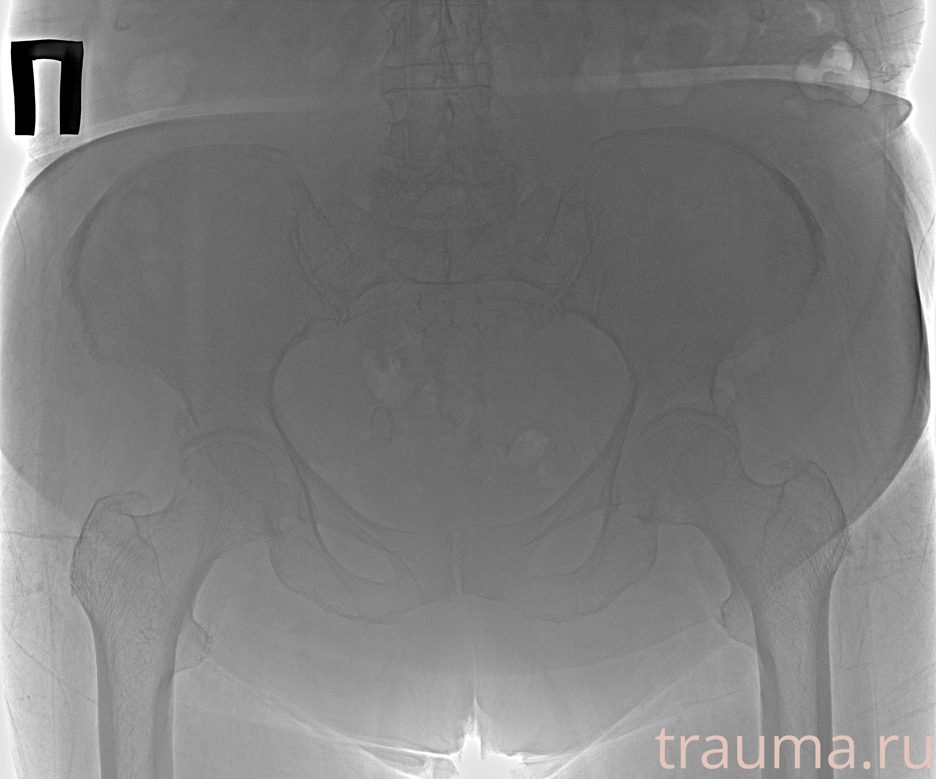 Рентген на дому: по вашему адресу приезжает врач-рентгенолог, травматолог-ортопед с мобильным рентгеновским аппаратом, проводит диагностику травмы или заболевания, делает необходимые рентгенограммы, дает рекомендации по дальнейшему лечению. Получить качественные снимки в домашних условиях возможно благодаря уникальной методике, разработанной МосРентген Центром для института  Склифосовского