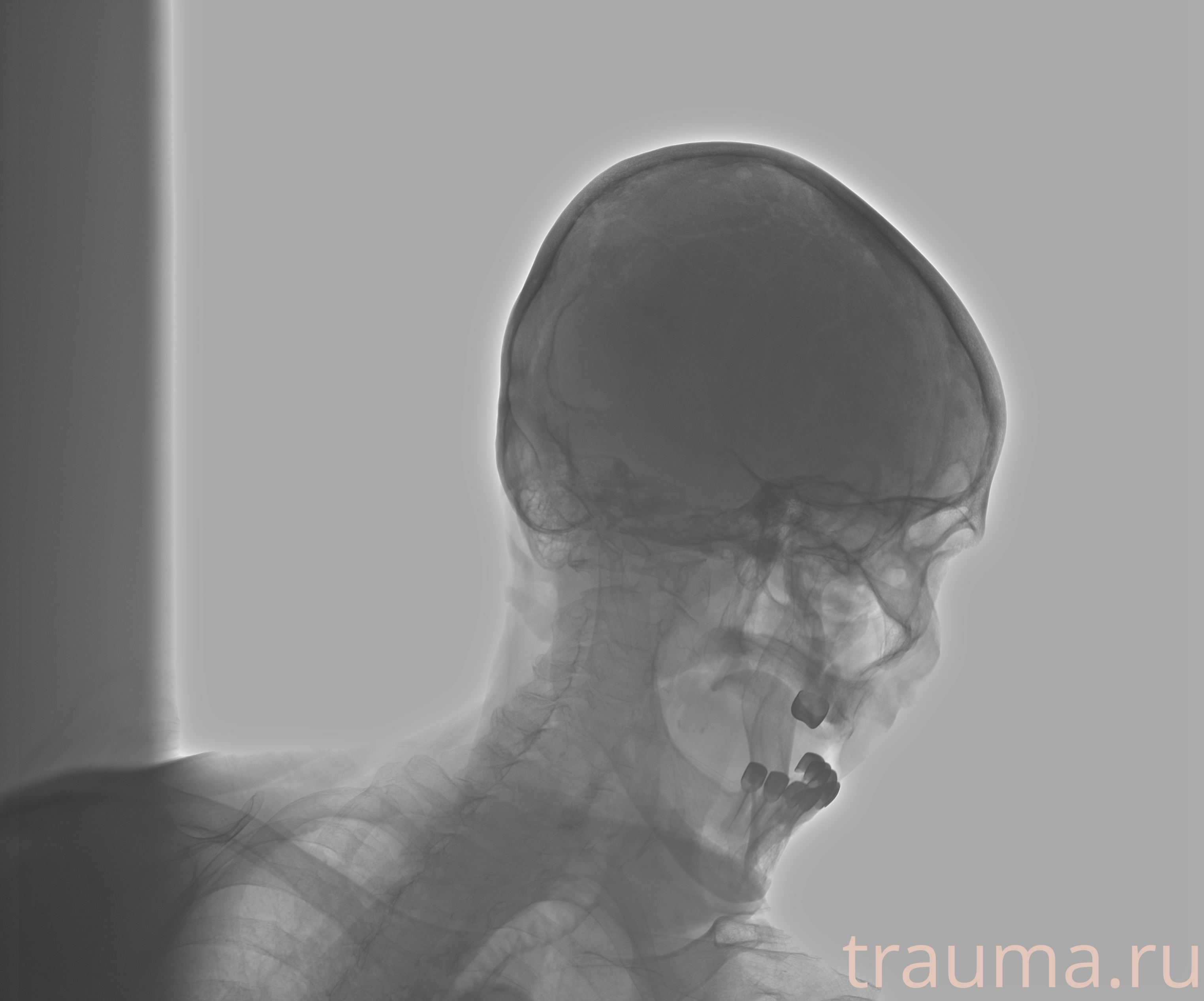 Рентген на дому: по вашему адресу приезжает врач-рентгенолог, травматолог-ортопед с мобильным рентгеновским аппаратом, проводит диагностику травмы или заболевания, делает необходимые рентгенограммы, дает рекомендации по дальнейшему лечению. Получить качественные снимки в домашних условиях возможно благодаря уникальной методике, разработанной МосРентген Центром для института  Склифосовского