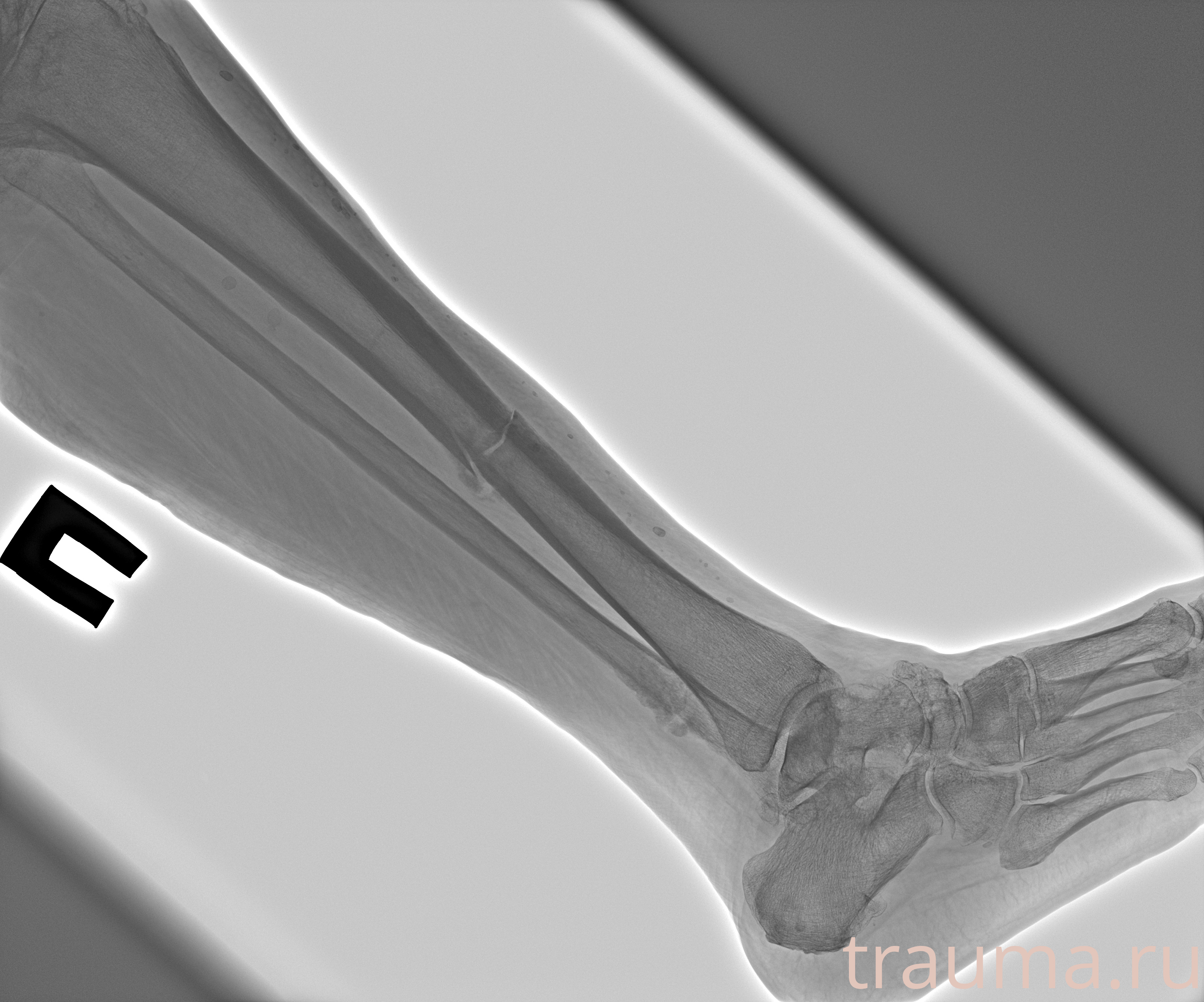 Рентген на дому: по вашему адресу приезжает врач-рентгенолог, травматолог-ортопед с мобильным рентгеновским аппаратом, проводит диагностику травмы или заболевания, делает необходимые рентгенограммы, дает рекомендации по дальнейшему лечению. Получить качественные снимки в домашних условиях возможно благодаря уникальной методике, разработанной МосРентген Центром для института  Склифосовского