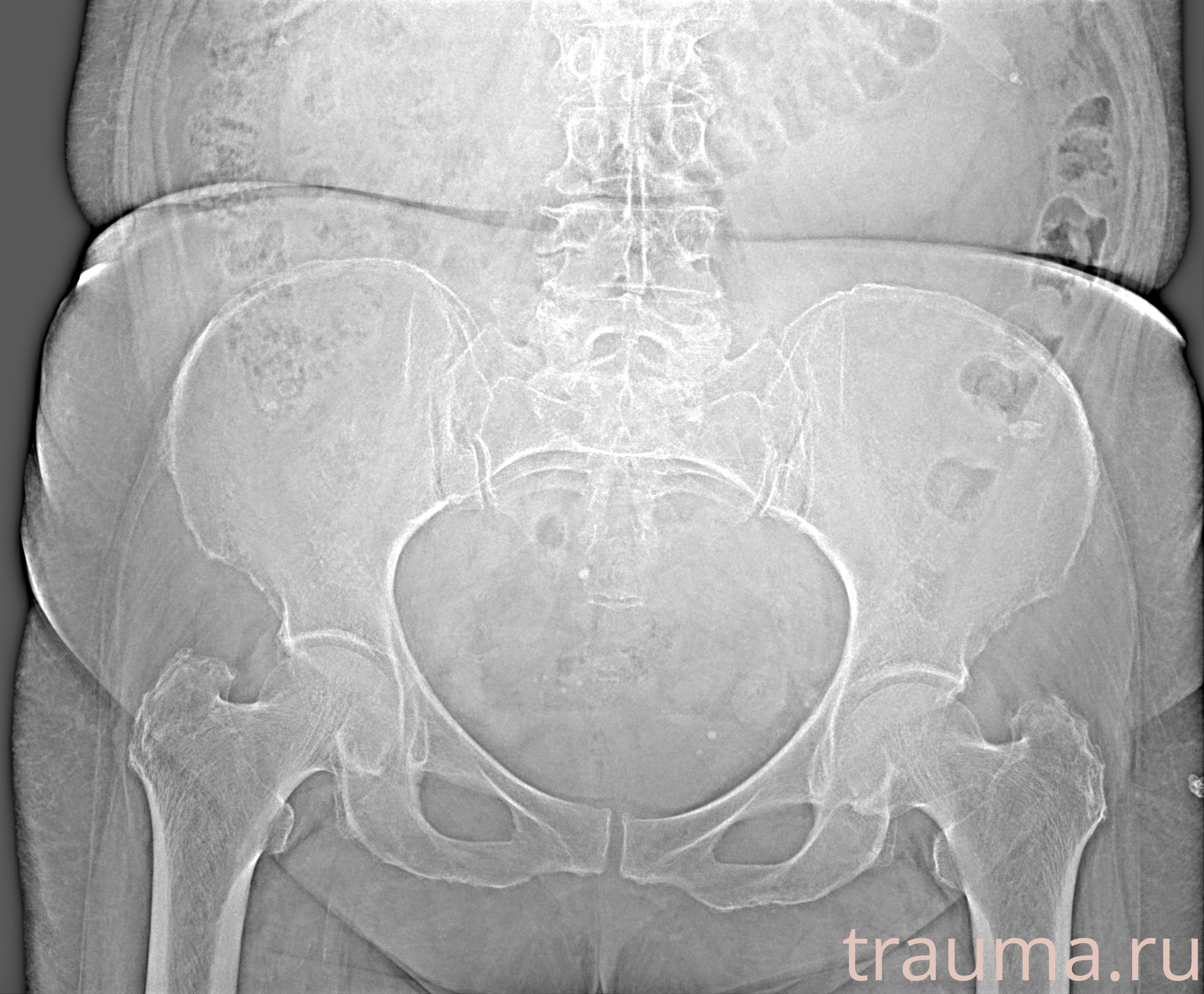 Рентген на дому: по вашему адресу приезжает врач-рентгенолог, травматолог-ортопед с мобильным рентгеновским аппаратом, проводит диагностику травмы или заболевания, делает необходимые рентгенограммы, дает рекомендации по дальнейшему лечению. Получить качественные снимки в домашних условиях возможно благодаря уникальной методике, разработанной МосРентген Центром для института  Склифосовского