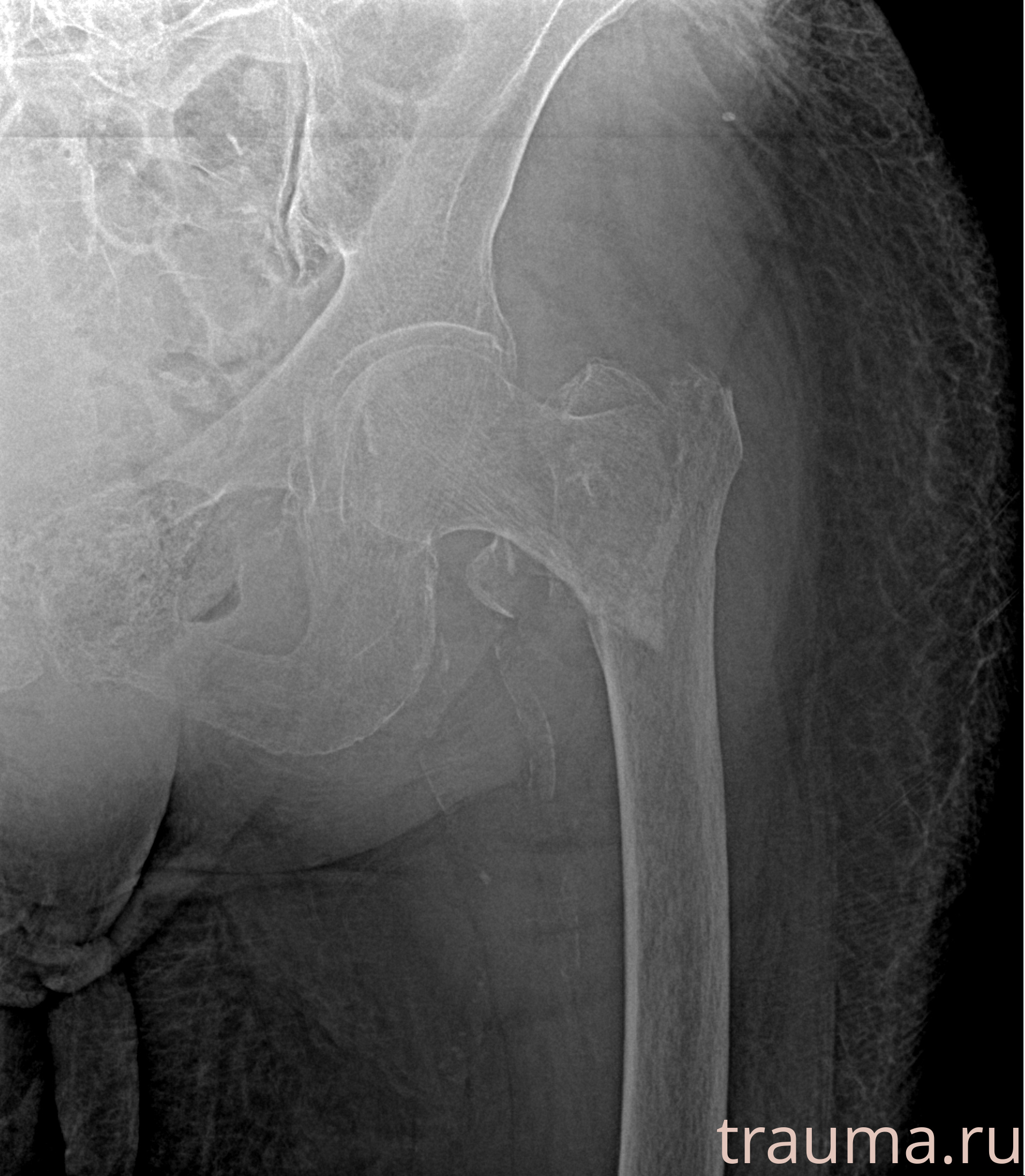 Рентген на дому: по вашему адресу приезжает врач-рентгенолог, травматолог-ортопед с мобильным рентгеновским аппаратом, проводит диагностику травмы или заболевания, делает необходимые рентгенограммы, дает рекомендации по дальнейшему лечению. Получить качественные снимки в домашних условиях возможно благодаря уникальной методике, разработанной МосРентген Центром для института  Склифосовского