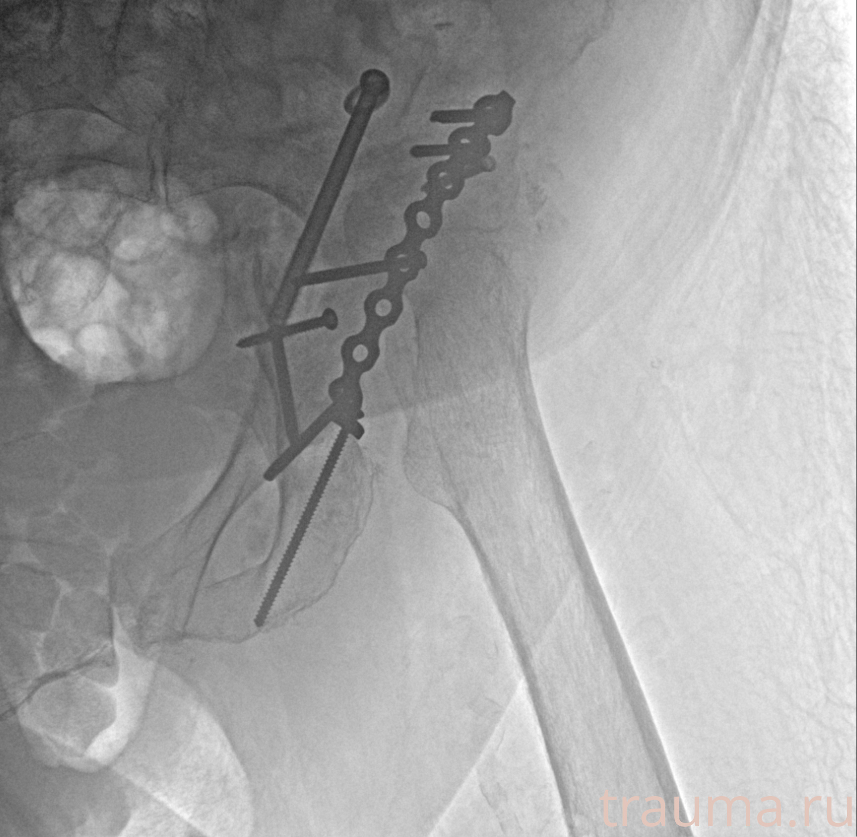 Рентген на дому: по вашему адресу приезжает врач-рентгенолог, травматолог-ортопед с мобильным рентгеновским аппаратом, проводит диагностику травмы или заболевания, делает необходимые рентгенограммы, дает рекомендации по дальнейшему лечению. Получить качественные снимки в домашних условиях возможно благодаря уникальной методике, разработанной МосРентген Центром для института  Склифосовского