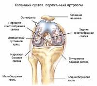 Оперативное лечение гетерогенного деформирующего артроза коленного сустава Оперативное лечение гетерогенного деформирующего артроза коленного сустава