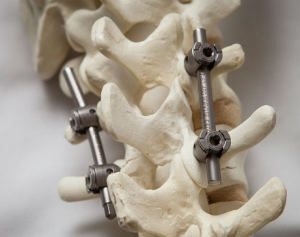 Факторы, влияющие на стабильность транспедикулярной фиксации при лечении пациентов с застарелыми переломами позвоночника на фоне остеопороза