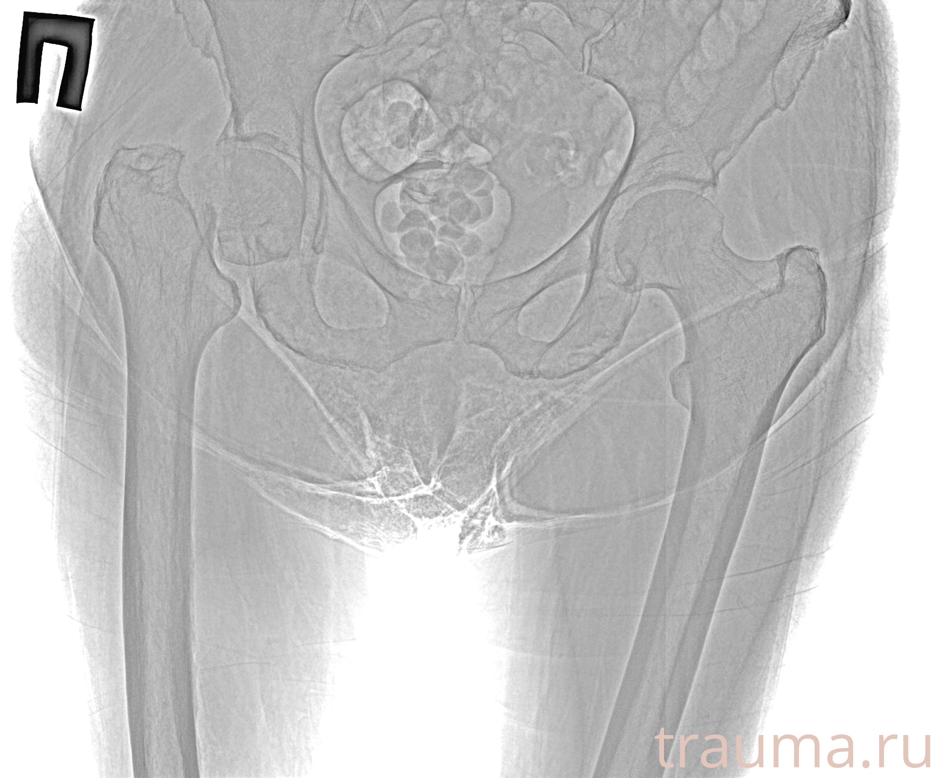 Рентген на дому: по вашему адресу приезжает врач-рентгенолог, травматолог-ортопед с мобильным рентгеновским аппаратом, проводит диагностику травмы или заболевания, делает необходимые рентгенограммы, дает рекомендации по дальнейшему лечению. Получить качественные снимки в домашних условиях возможно благодаря уникальной методике, разработанной МосРентген Центром для института  Склифосовского