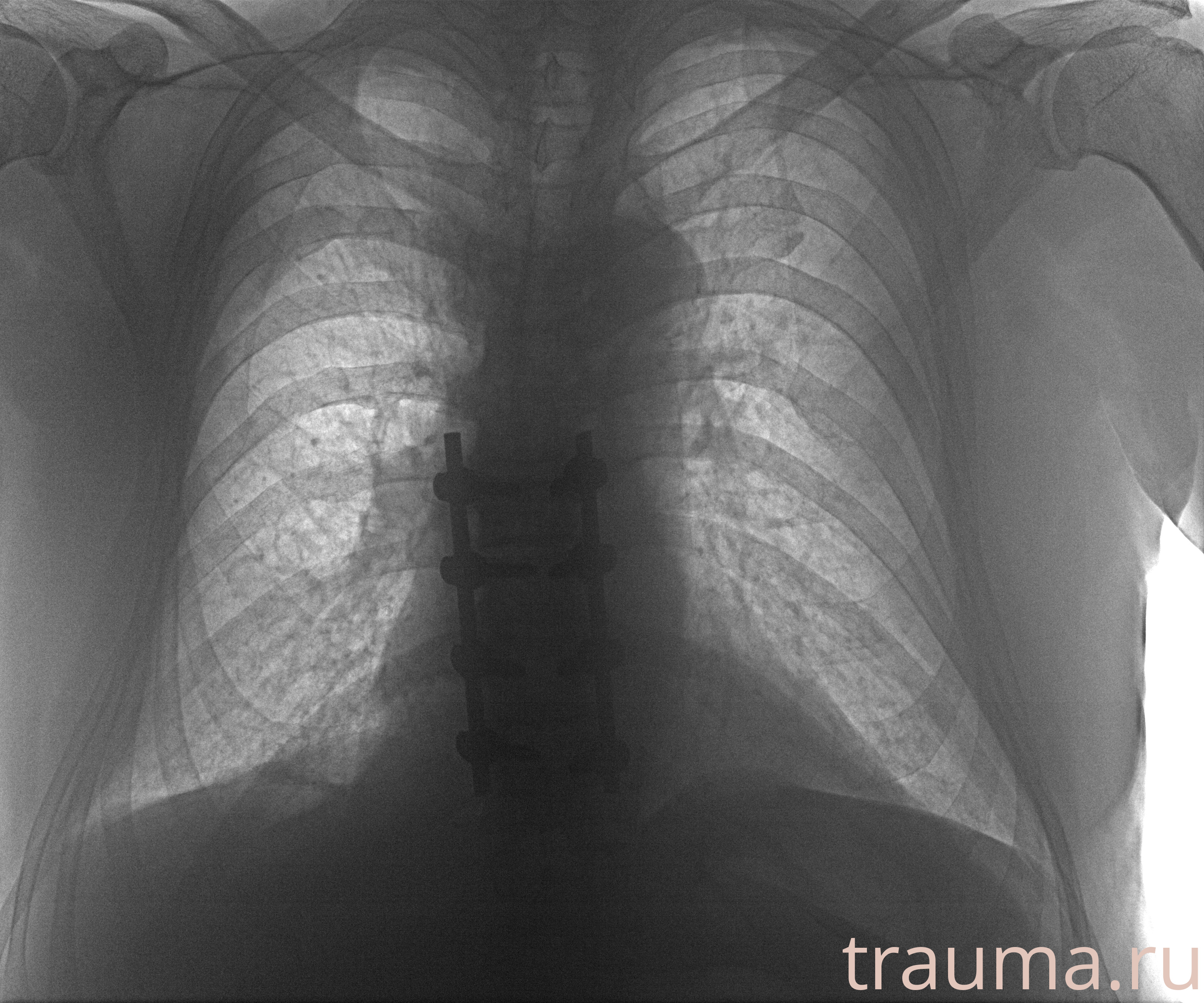 Рентген на дому: по вашему адресу приезжает врач-рентгенолог, травматолог-ортопед с мобильным рентгеновским аппаратом, проводит диагностику травмы или заболевания, делает необходимые рентгенограммы, дает рекомендации по дальнейшему лечению. Получить качественные снимки в домашних условиях возможно благодаря уникальной методике, разработанной МосРентген Центром для института  Склифосовского