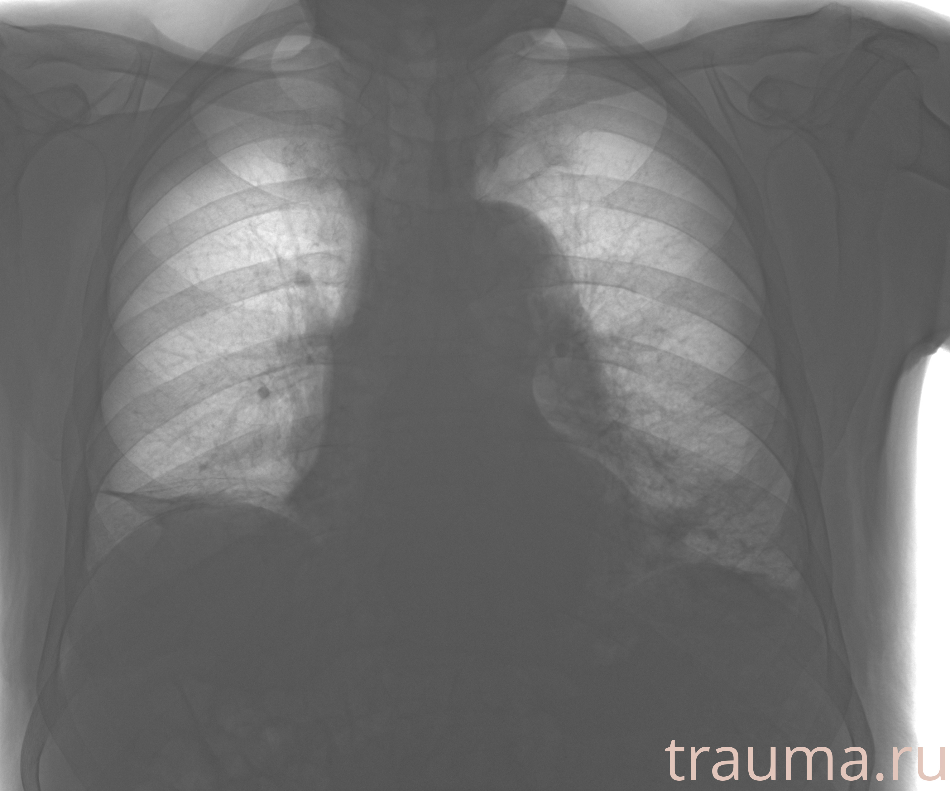 Рентген на дому: по вашему адресу приезжает врач-рентгенолог, травматолог-ортопед с мобильным рентгеновским аппаратом, проводит диагностику травмы или заболевания, делает необходимые рентгенограммы, дает рекомендации по дальнейшему лечению. Получить качественные снимки в домашних условиях возможно благодаря уникальной методике, разработанной МосРентген Центром для института  Склифосовского