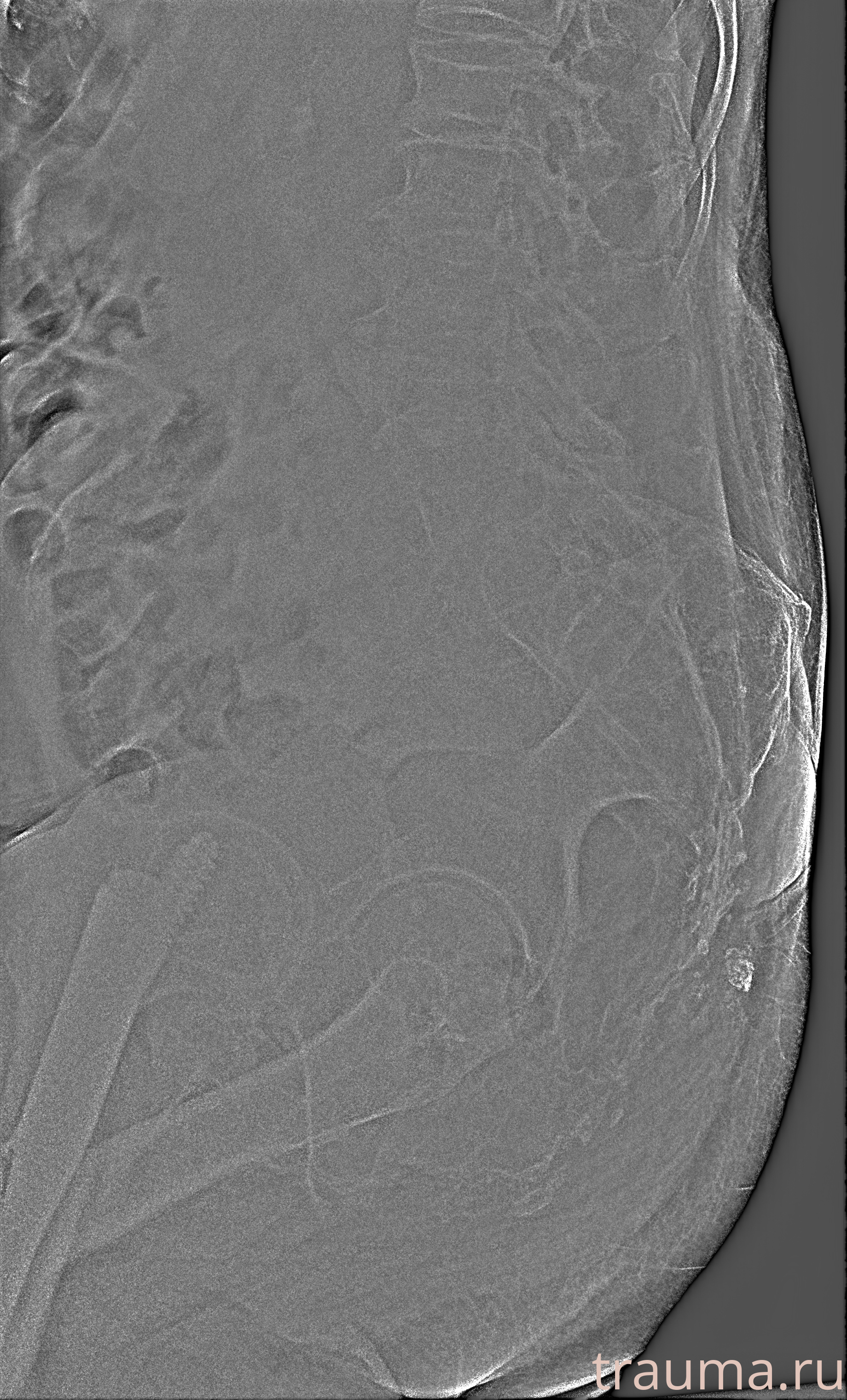 Рентген на дому: по вашему адресу приезжает врач-рентгенолог, травматолог-ортопед с мобильным рентгеновским аппаратом, проводит диагностику травмы или заболевания, делает необходимые рентгенограммы, дает рекомендации по дальнейшему лечению. Получить качественные снимки в домашних условиях возможно благодаря уникальной методике, разработанной МосРентген Центром для института  Склифосовского