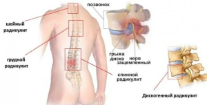 Дискогенная пояснично-крестцовая радикулопатия Дискогенная пояснично-крестцовая радикулопатия