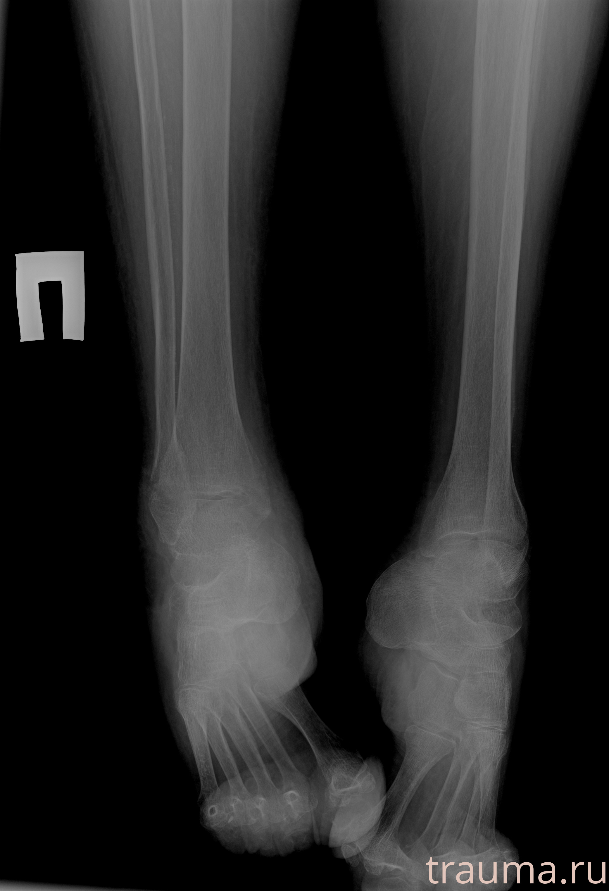 Рентген на дому: по вашему адресу приезжает врач-рентгенолог, травматолог-ортопед с мобильным рентгеновским аппаратом, проводит диагностику травмы или заболевания, делает необходимые рентгенограммы, дает рекомендации по дальнейшему лечению. Получить качественные снимки в домашних условиях возможно благодаря уникальной методике, разработанной МосРентген Центром для института  Склифосовского